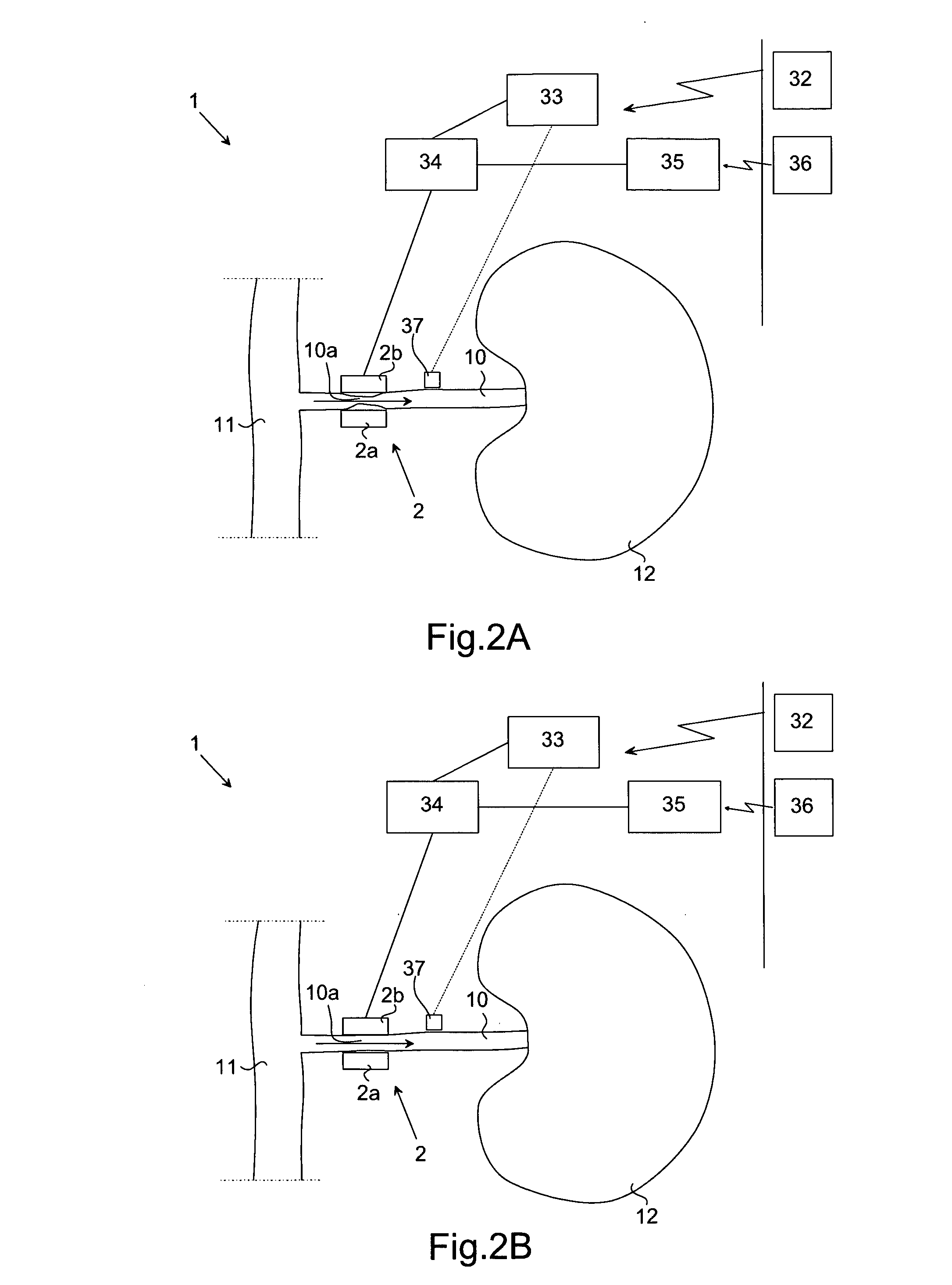 System and method for thermal treatment of hypertension, hypotension or aneurysm