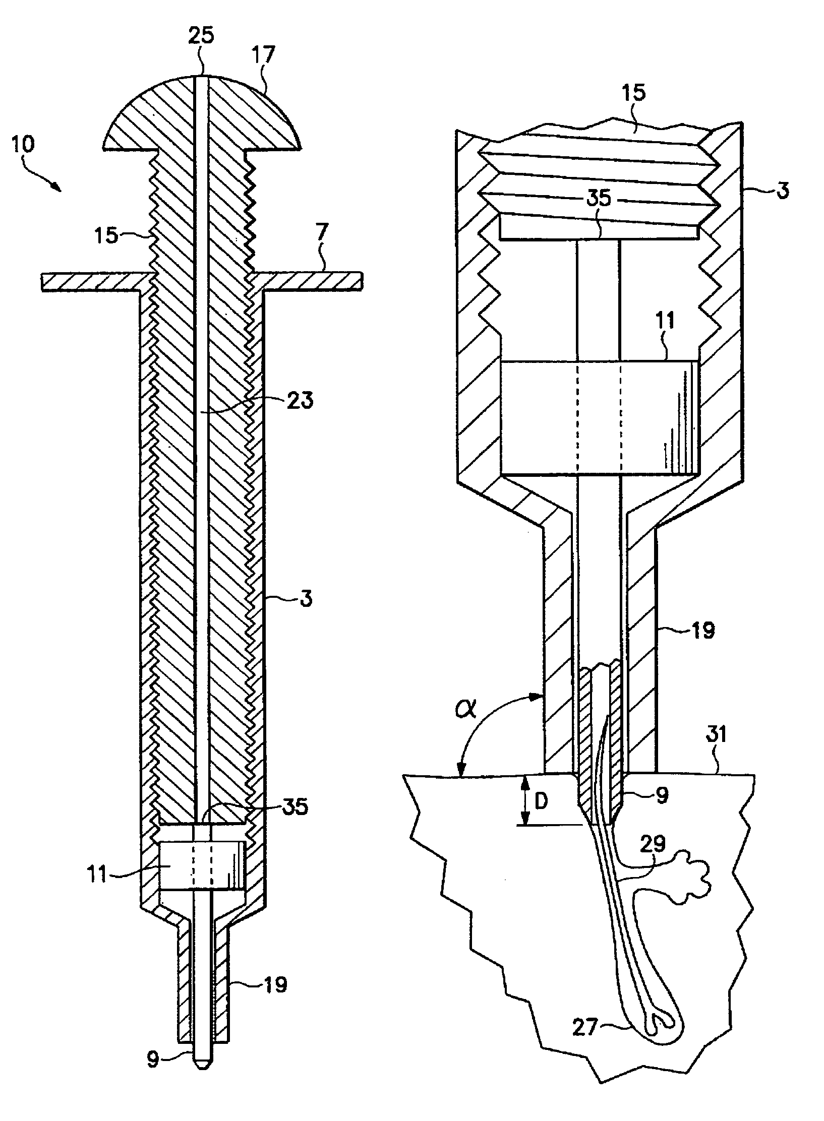 Follicular extraction punch and method