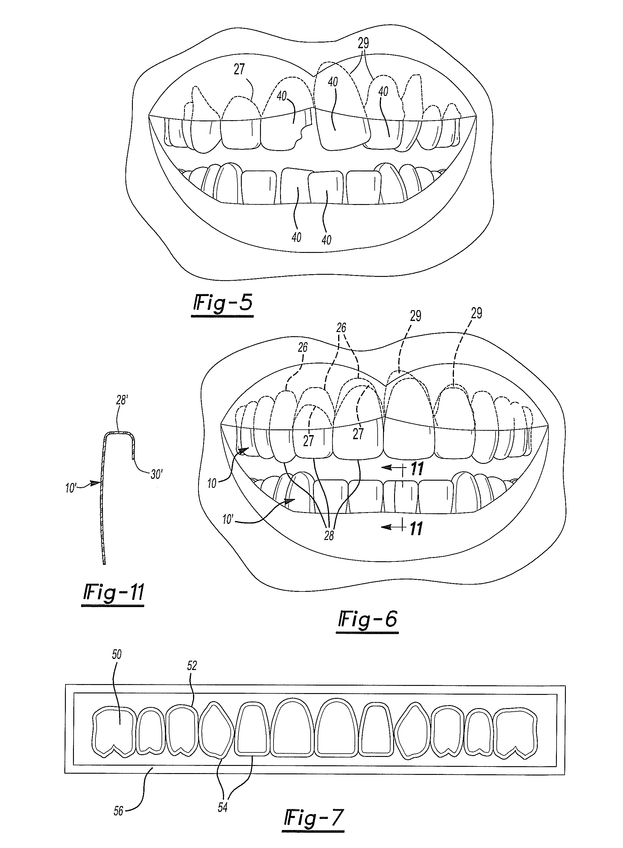 Method of using a demonstration dental template with digital representation for modeling dental restorations