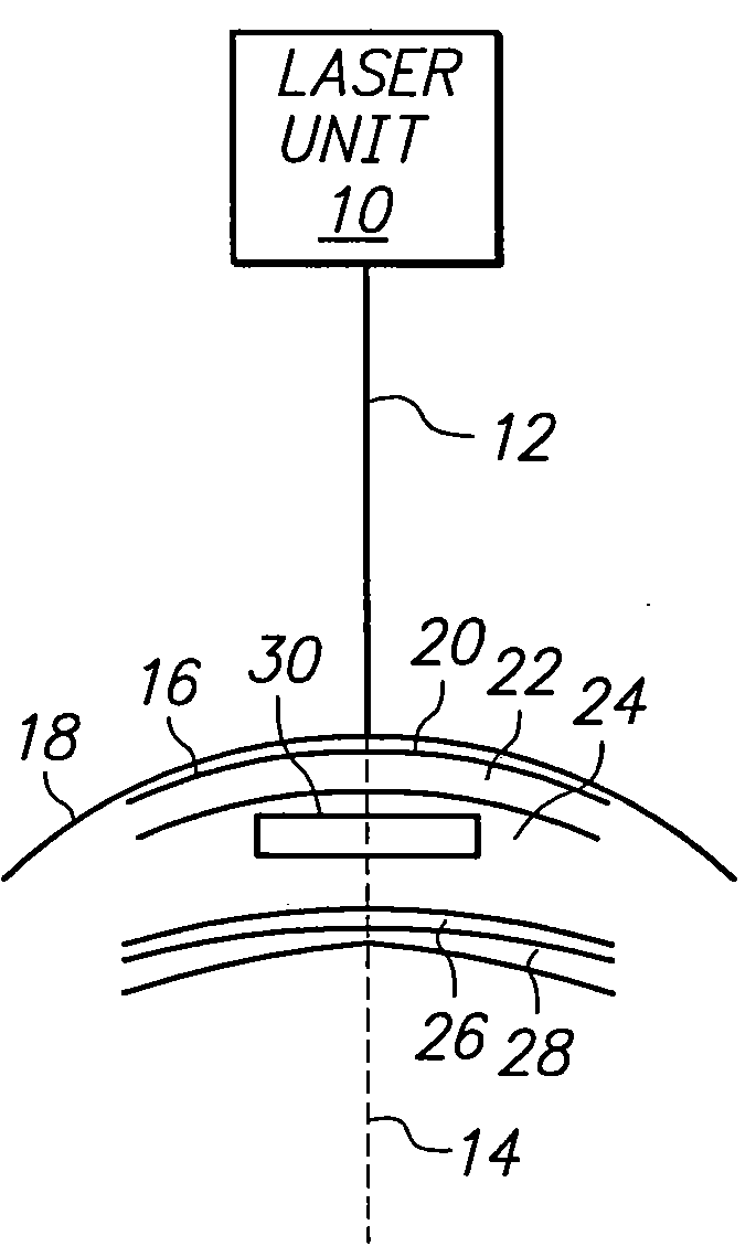 Method for harvesting corneal donor plugs for use in keratophakia procedures