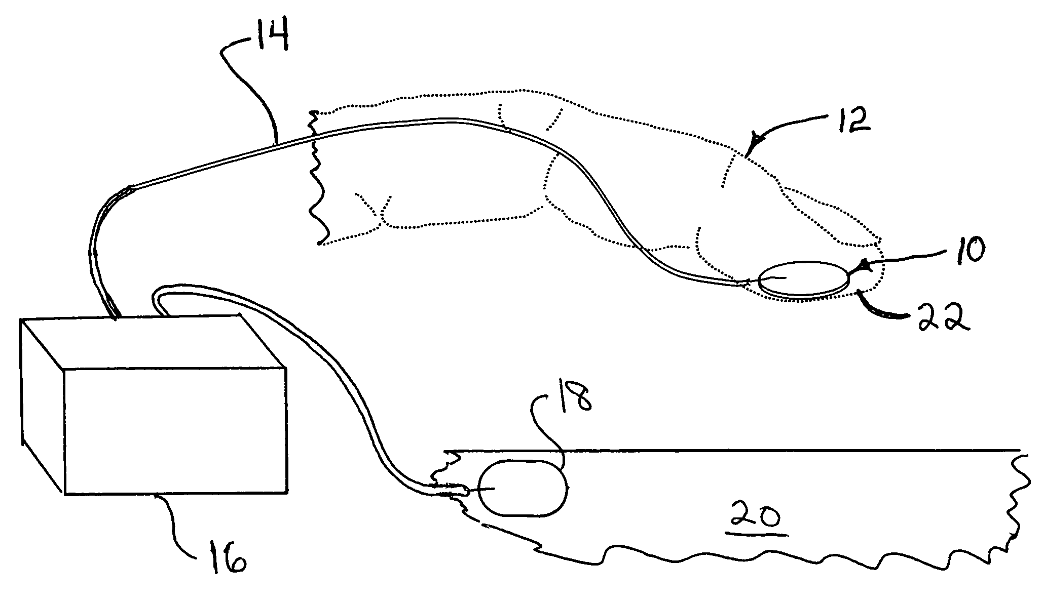 Transcutaneous electrical nerve locator