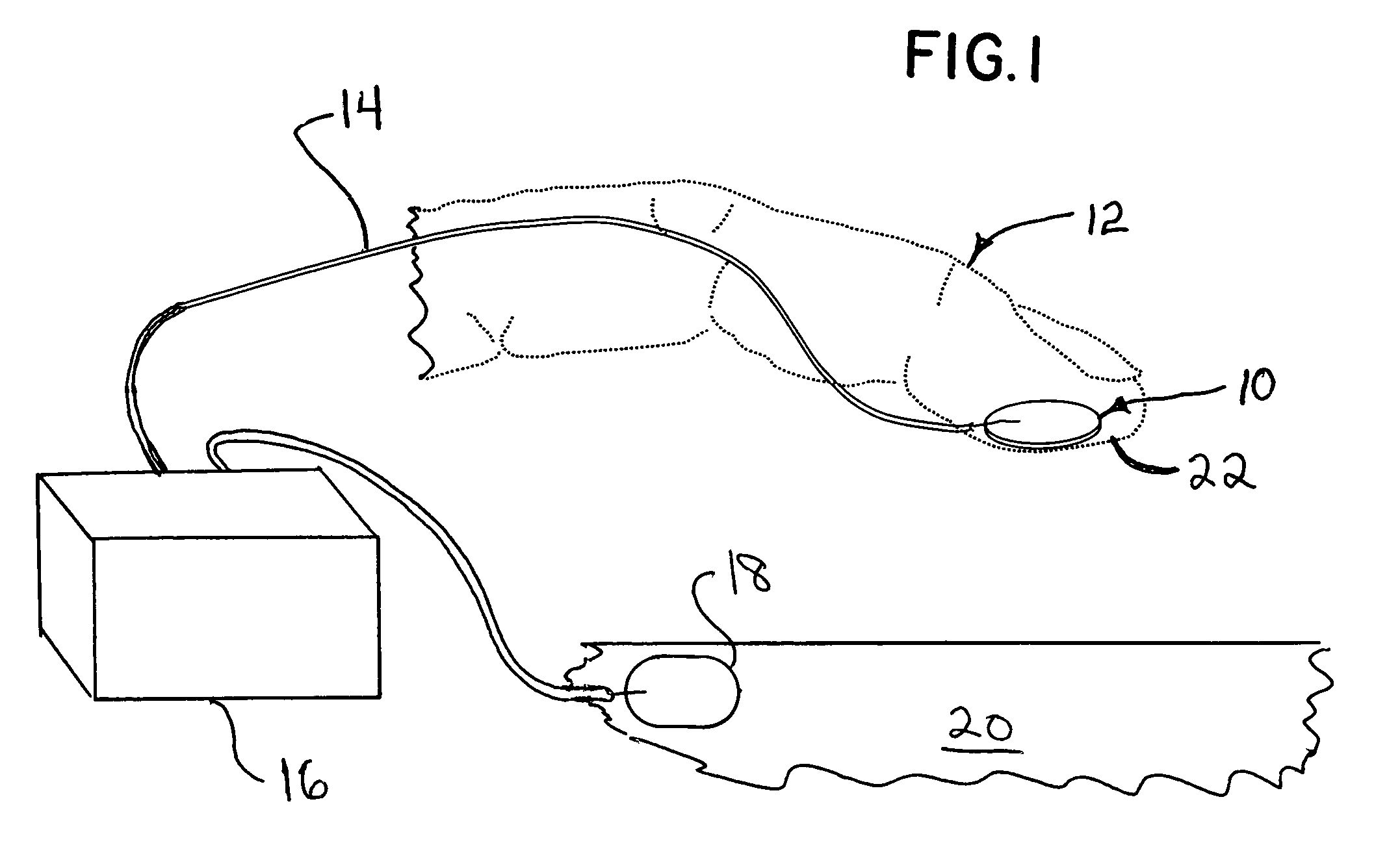 Transcutaneous electrical nerve locator