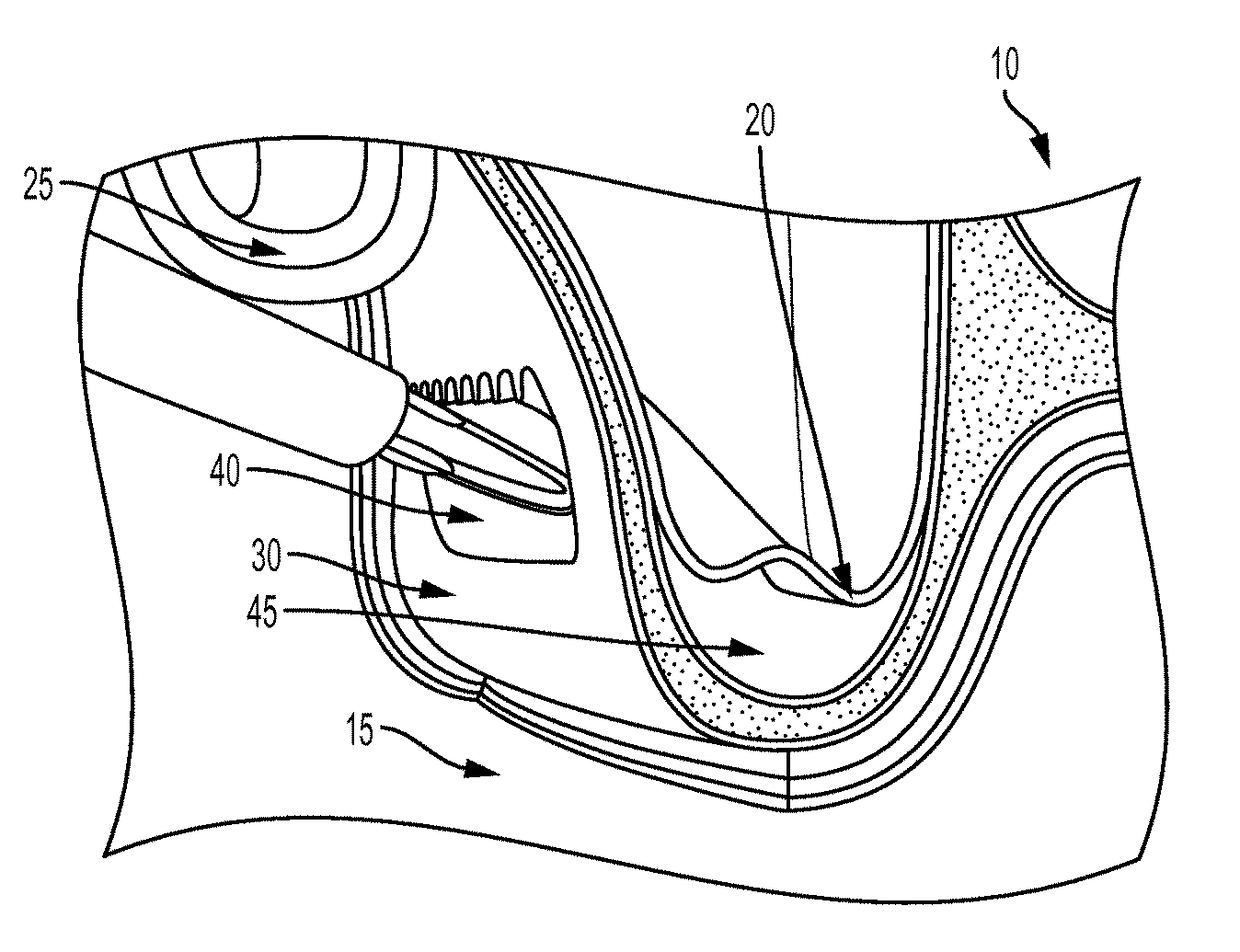 Method for conducting a guided sinus lift procedure