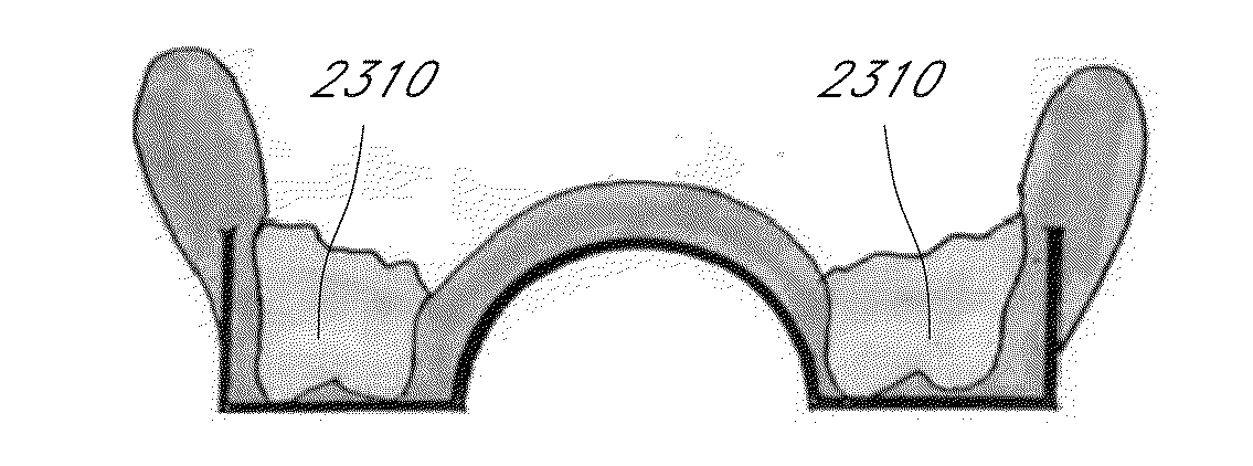 Hydraulic pressure dental impression