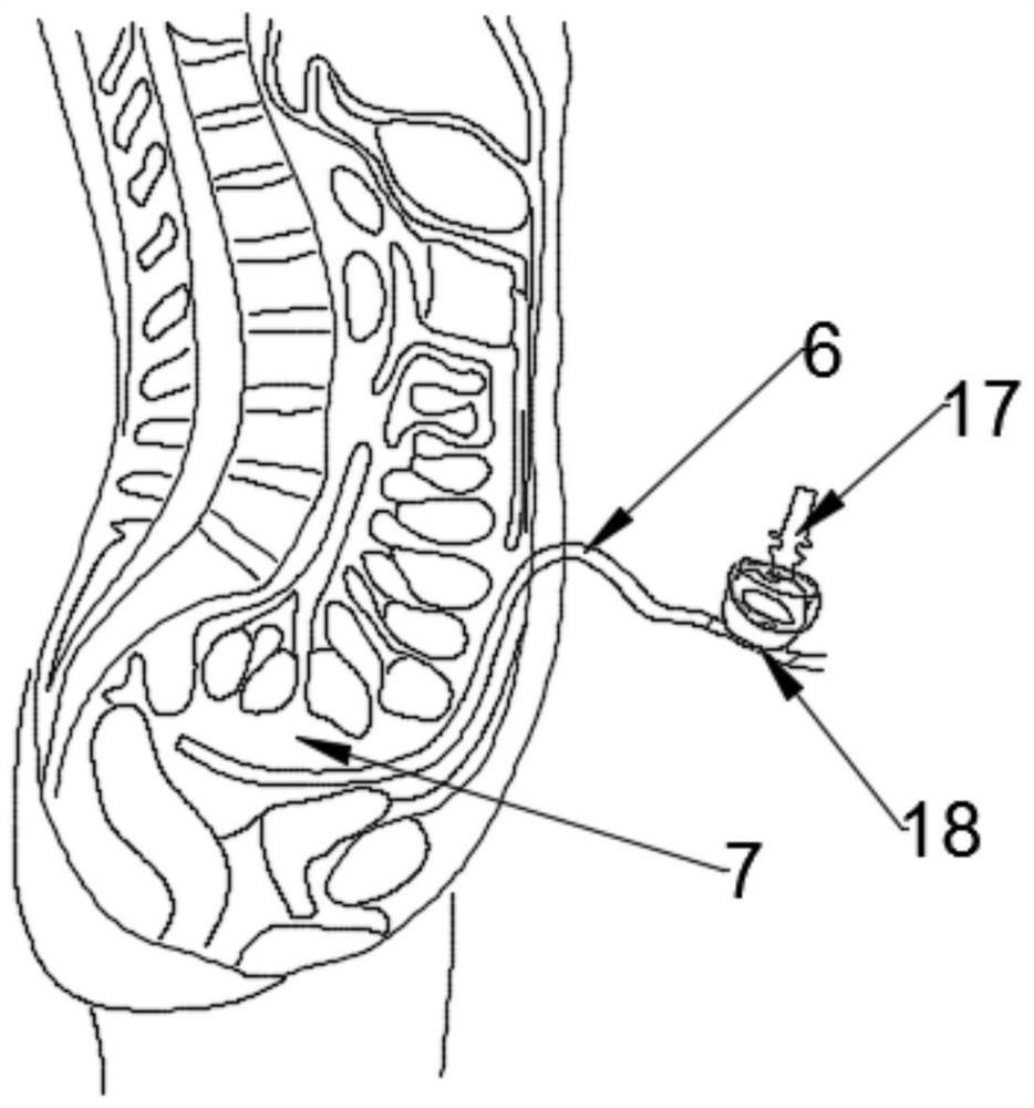 Multifunctional intraperitoneal pressure detector