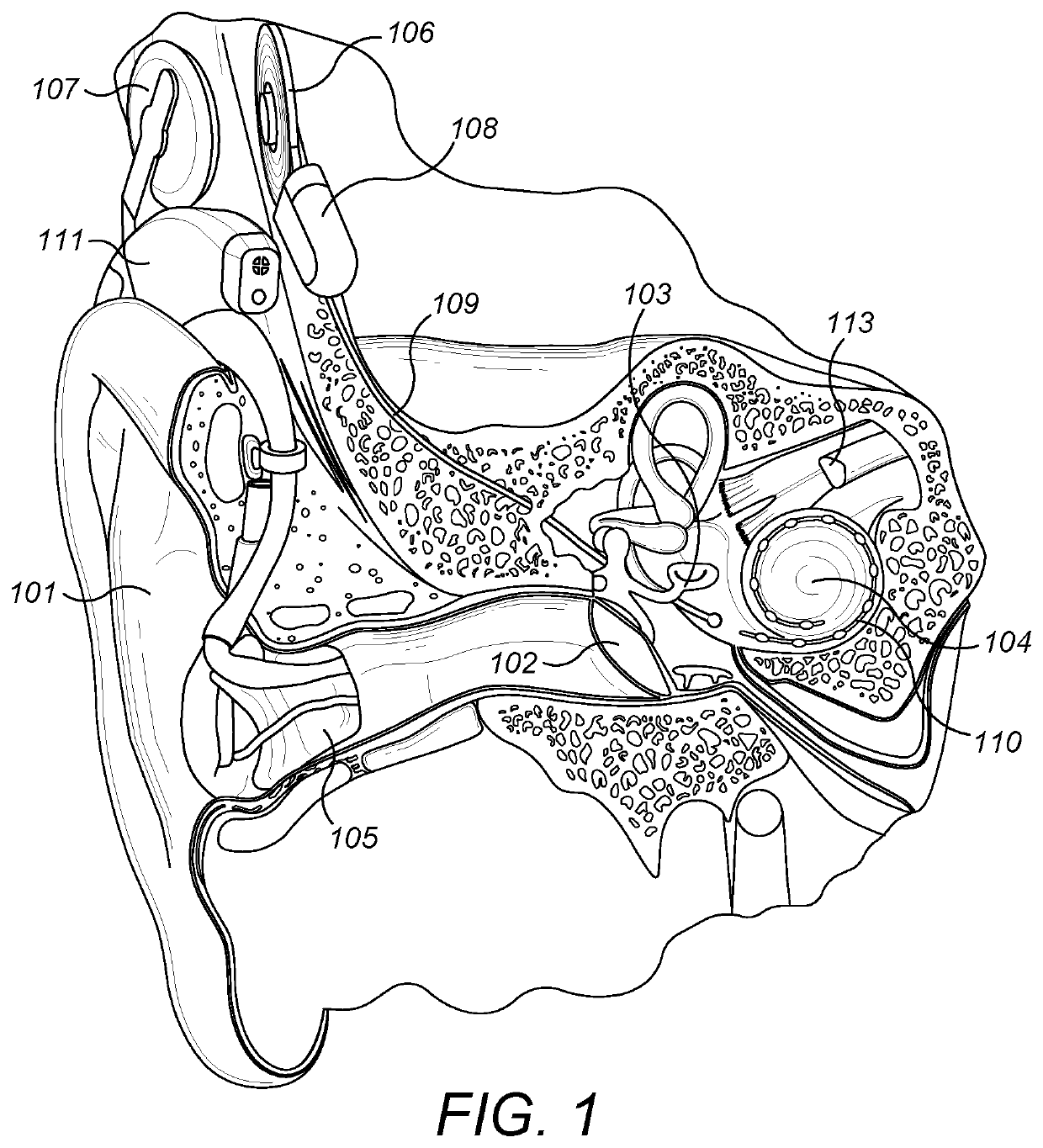 Middle Ear Implant Coupler for Mechanical Cochlea Stimulation via the Round Window