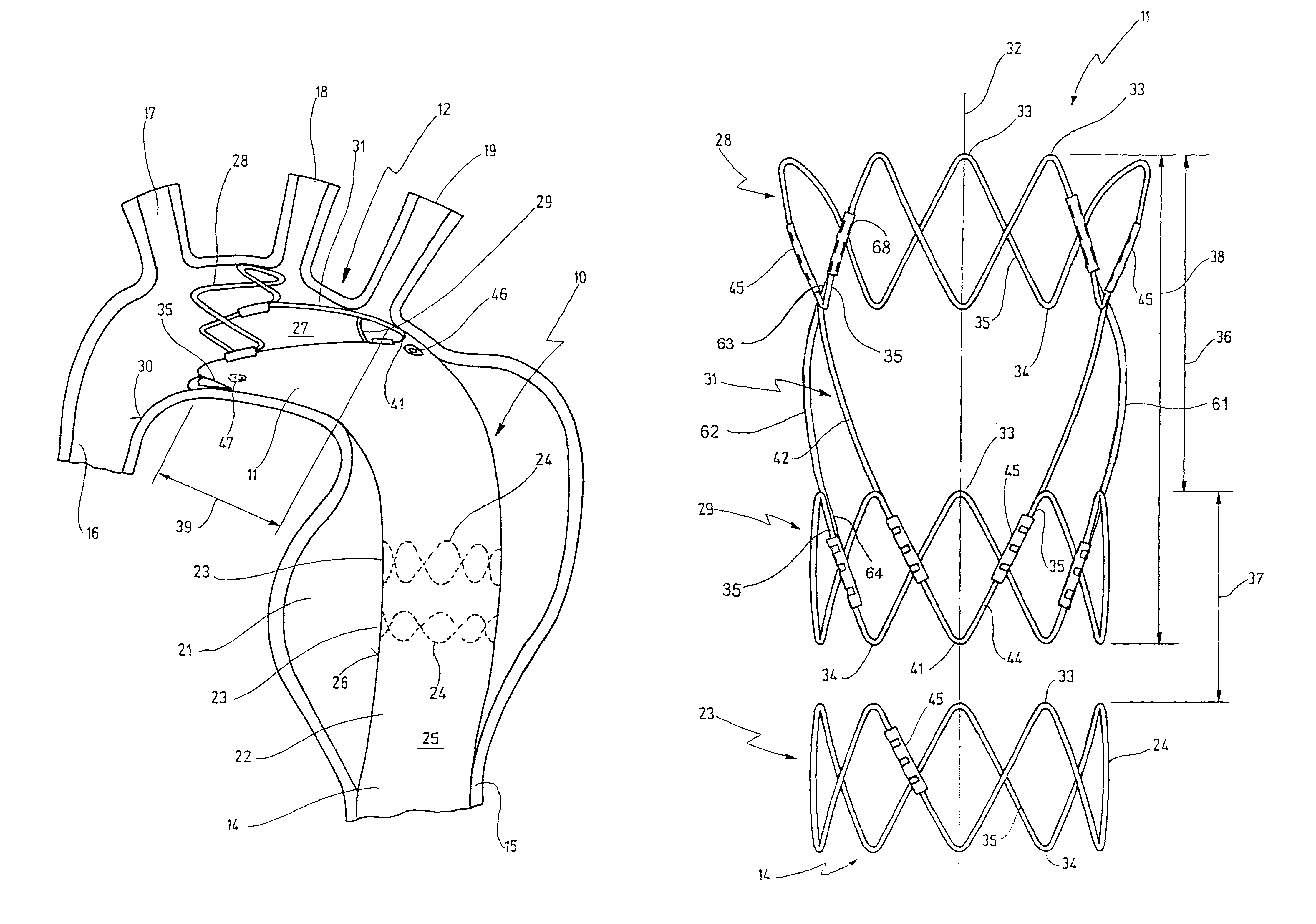 Stent for implantation in a blood vessel, especially in the region of the aortic arch