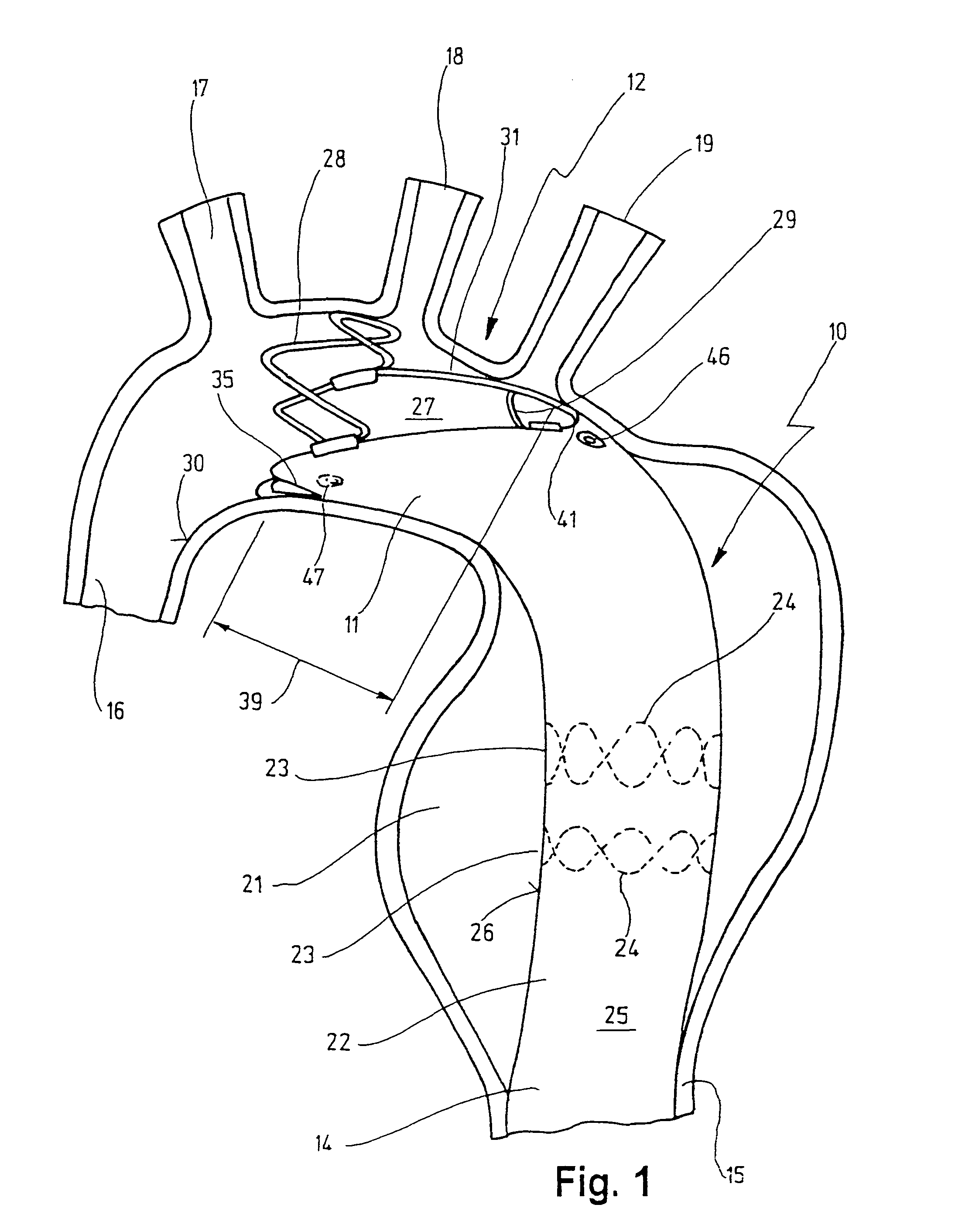 Stent for implantation in a blood vessel, especially in the region of the aortic arch