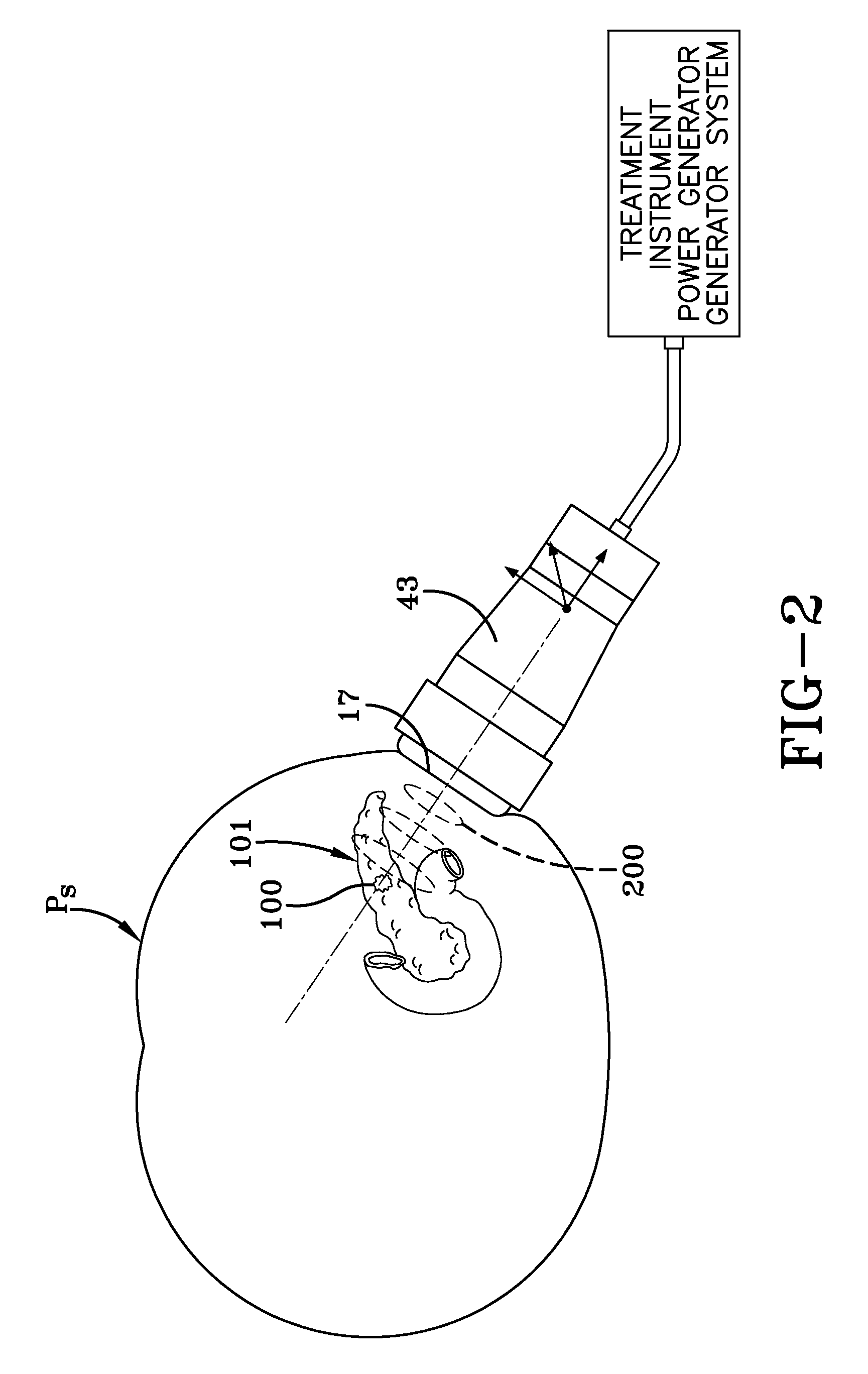 Pancreas regeneration treatment for diabetics using extracorporeal acoustic shock waves