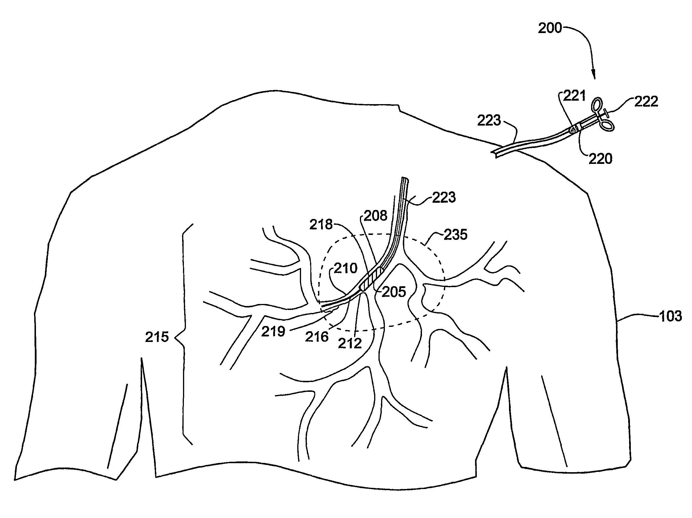 Method and system for positioning a device in a tubular organ