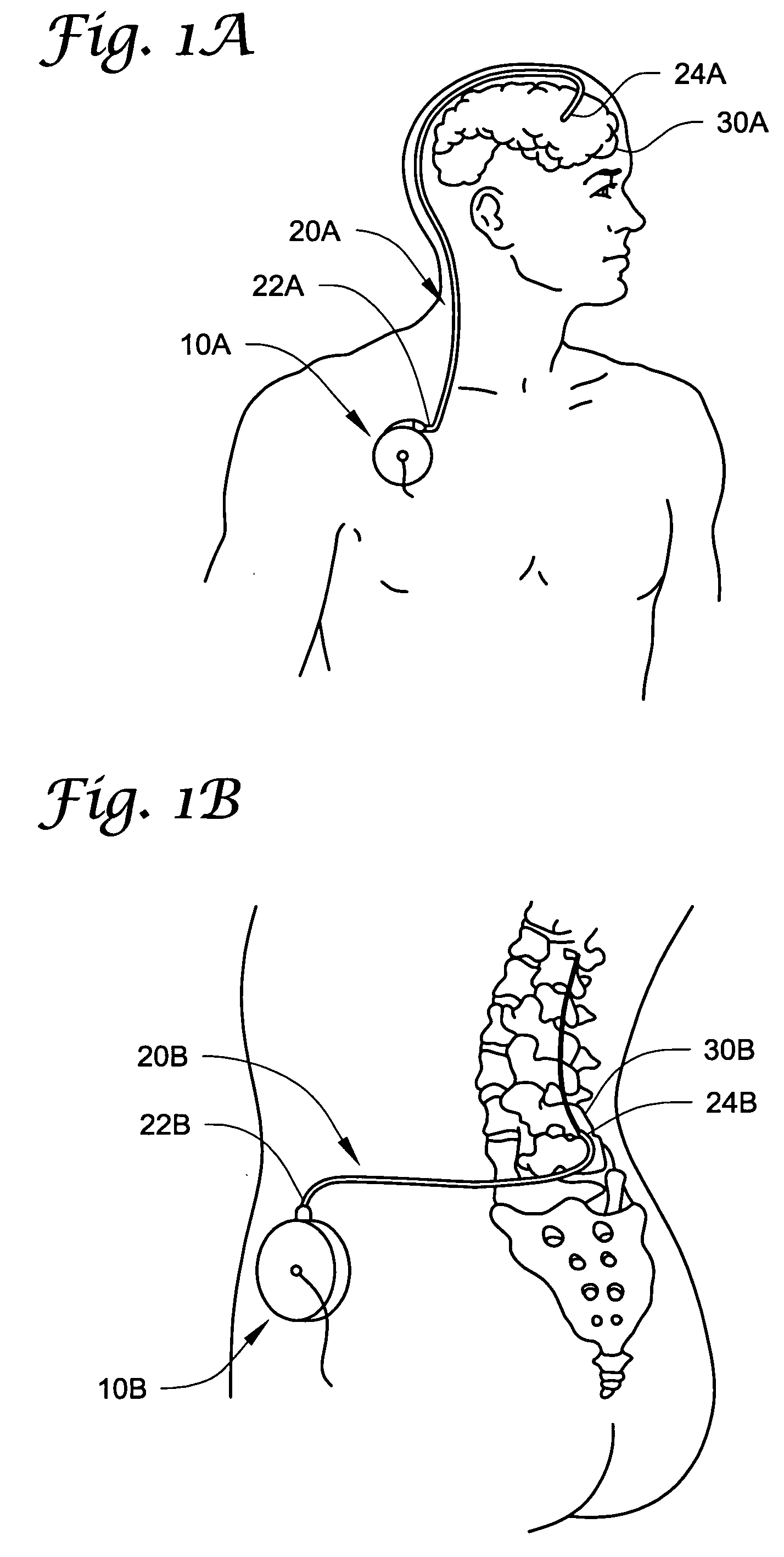 Catheters incorporating valves and permeable membranes