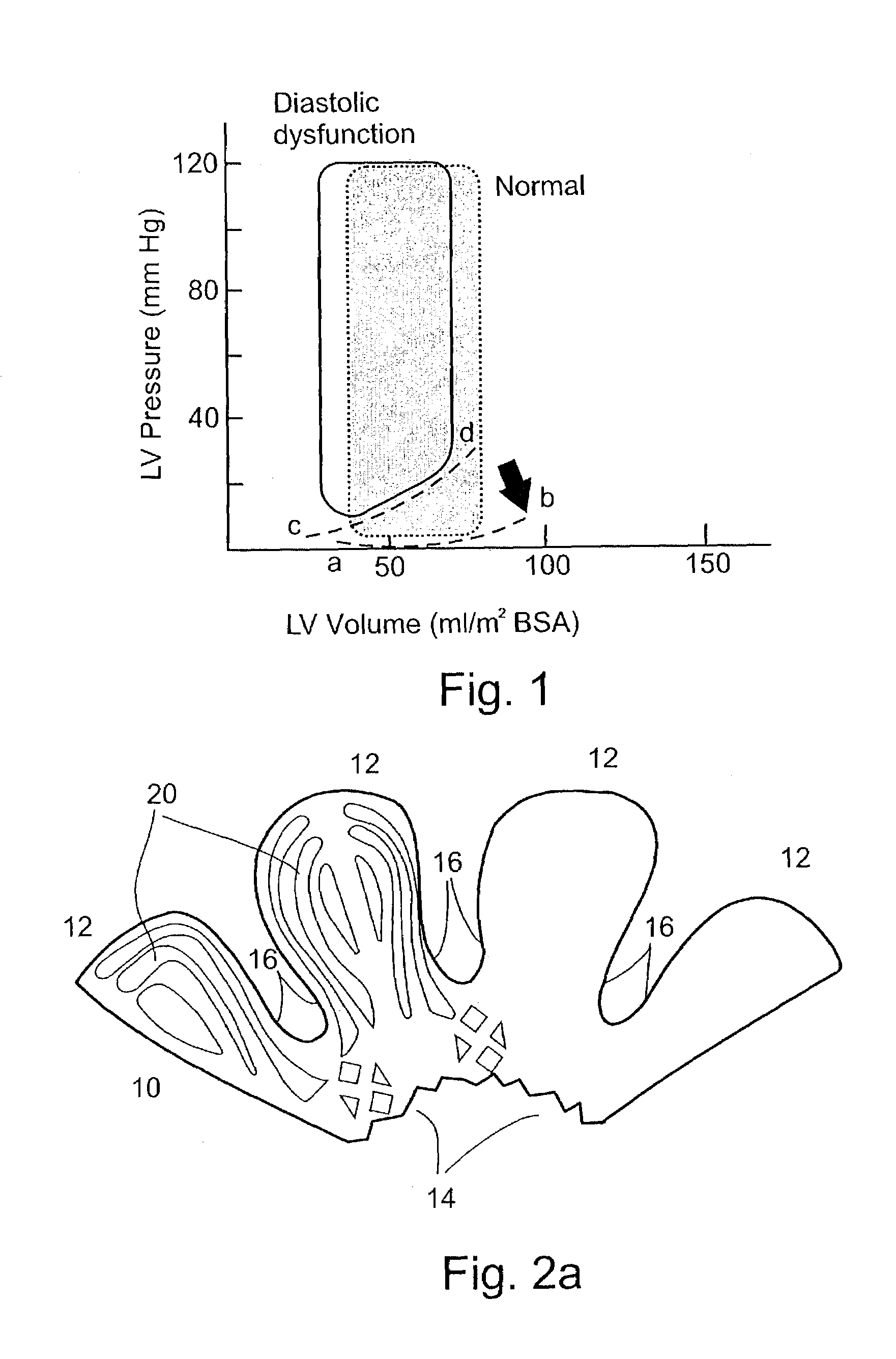 In-vivo method and device for improving diastolic function of the left ventricle