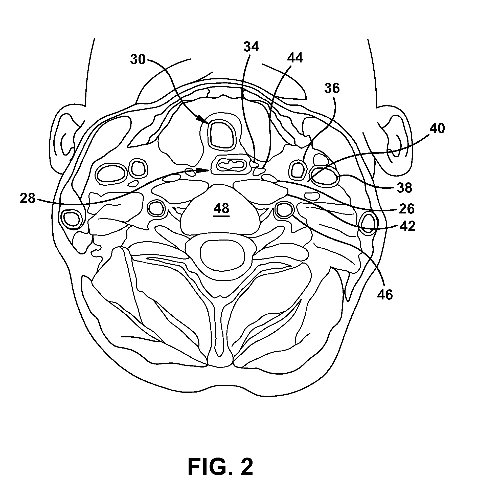 Ultrasound-guided delivery of a therapy delivery device to a nerve target