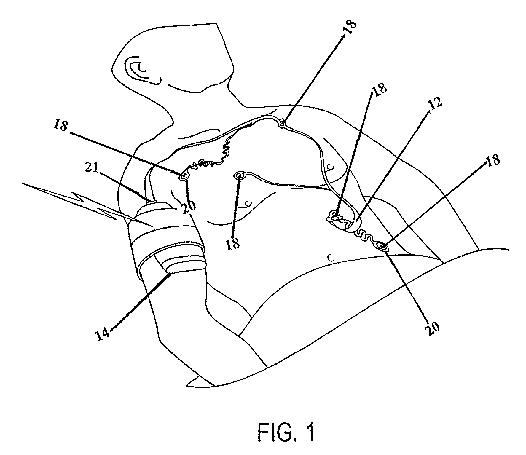 Radiolucent electrode assembly