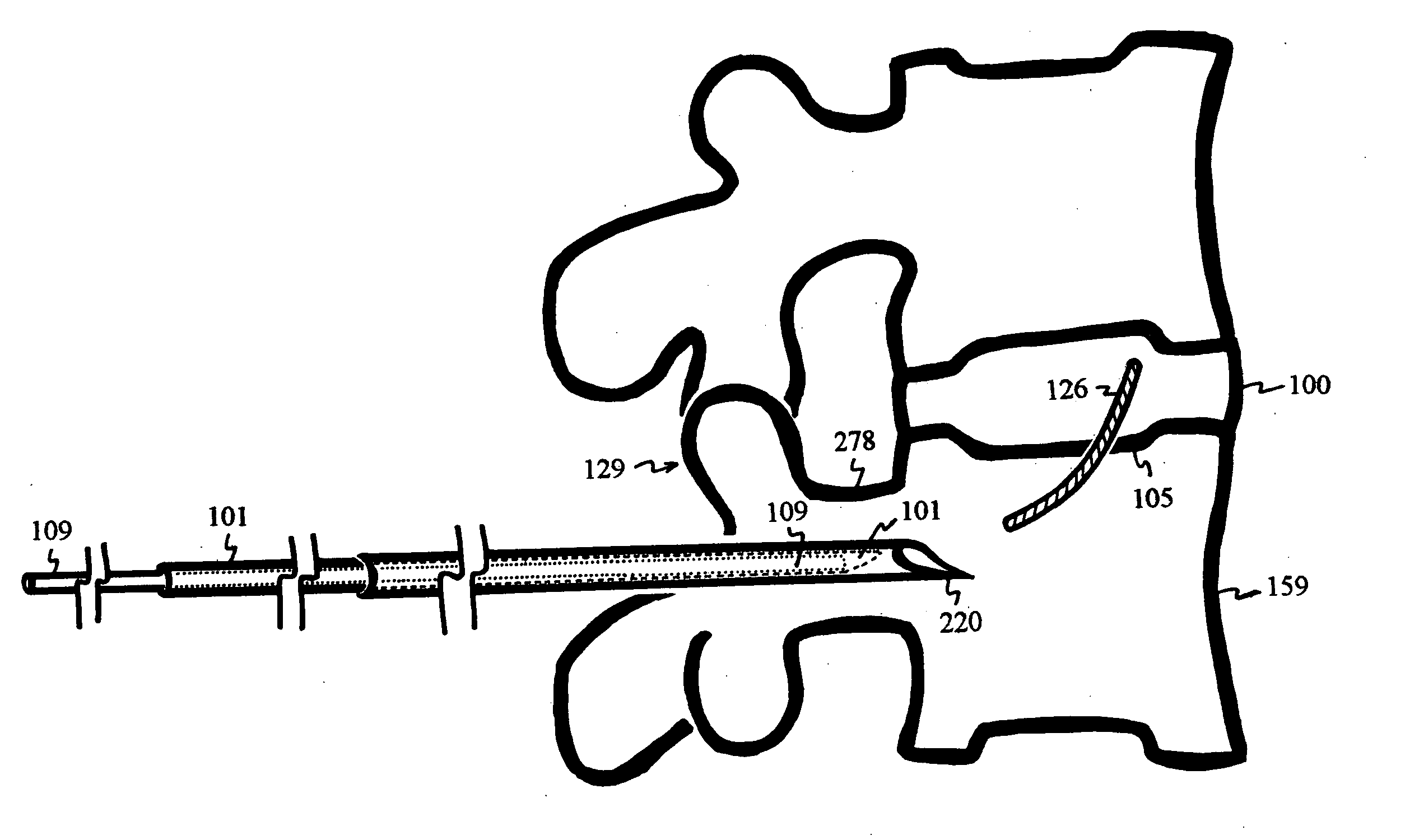 Disc shunt for treating back pain