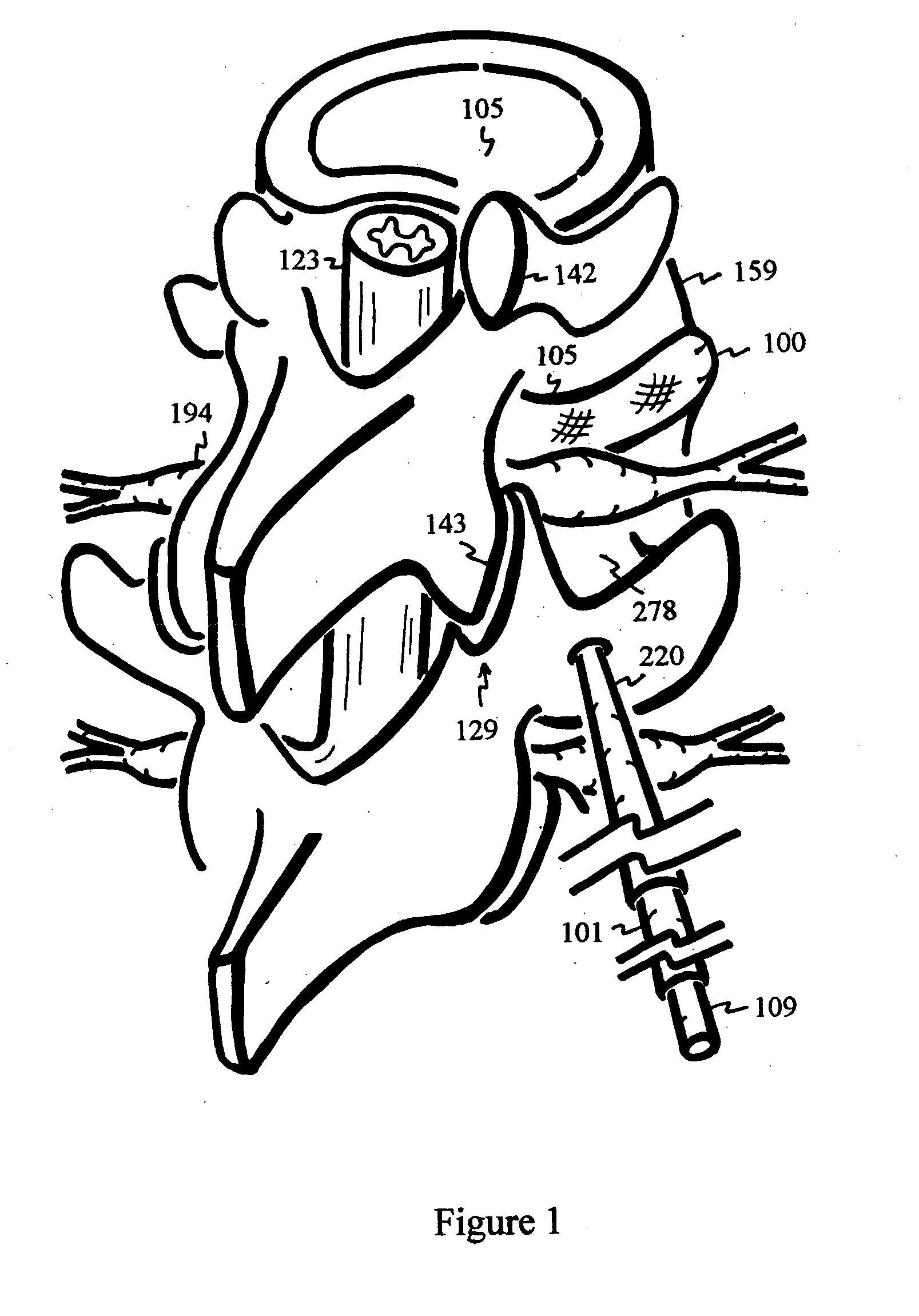 Disc shunt for treating back pain