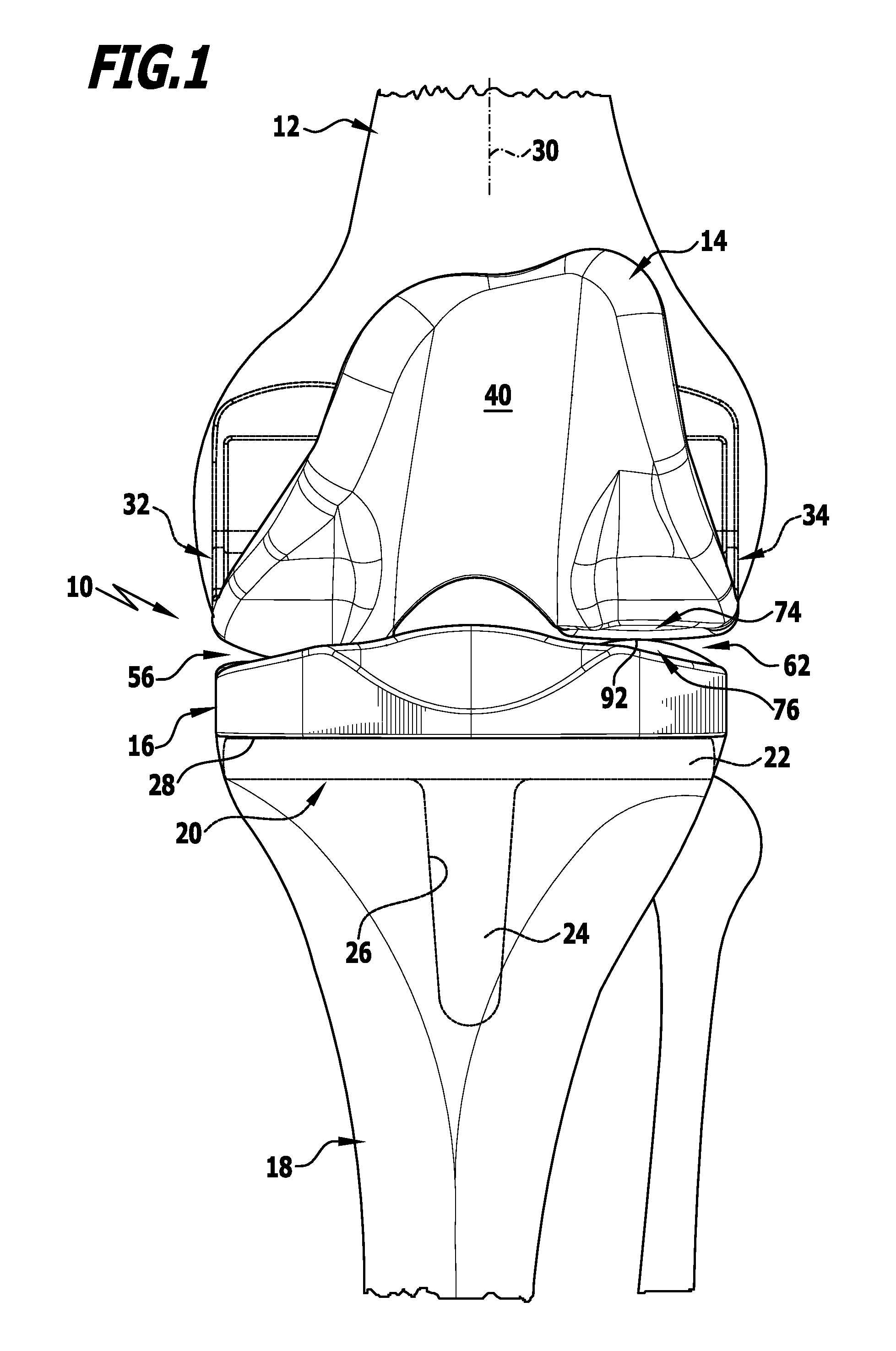 Knee joint endoprosthesis