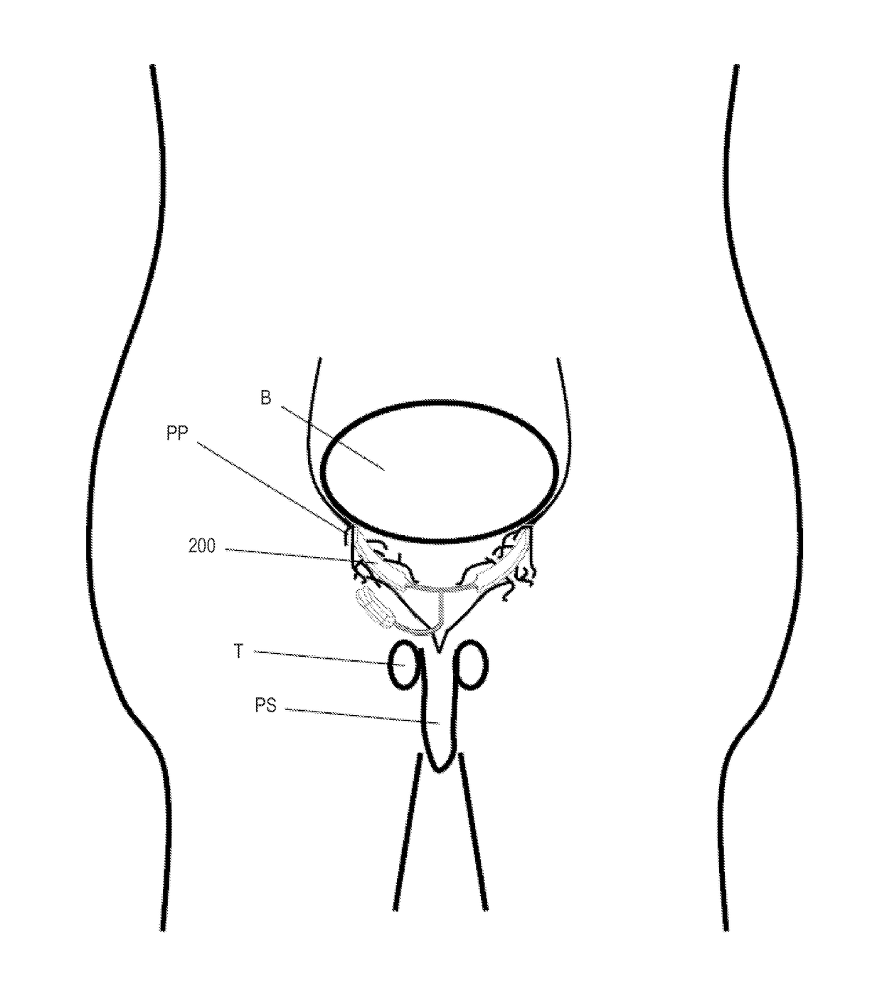 Systems and methods for treating sexual disorders using electro-stimulation