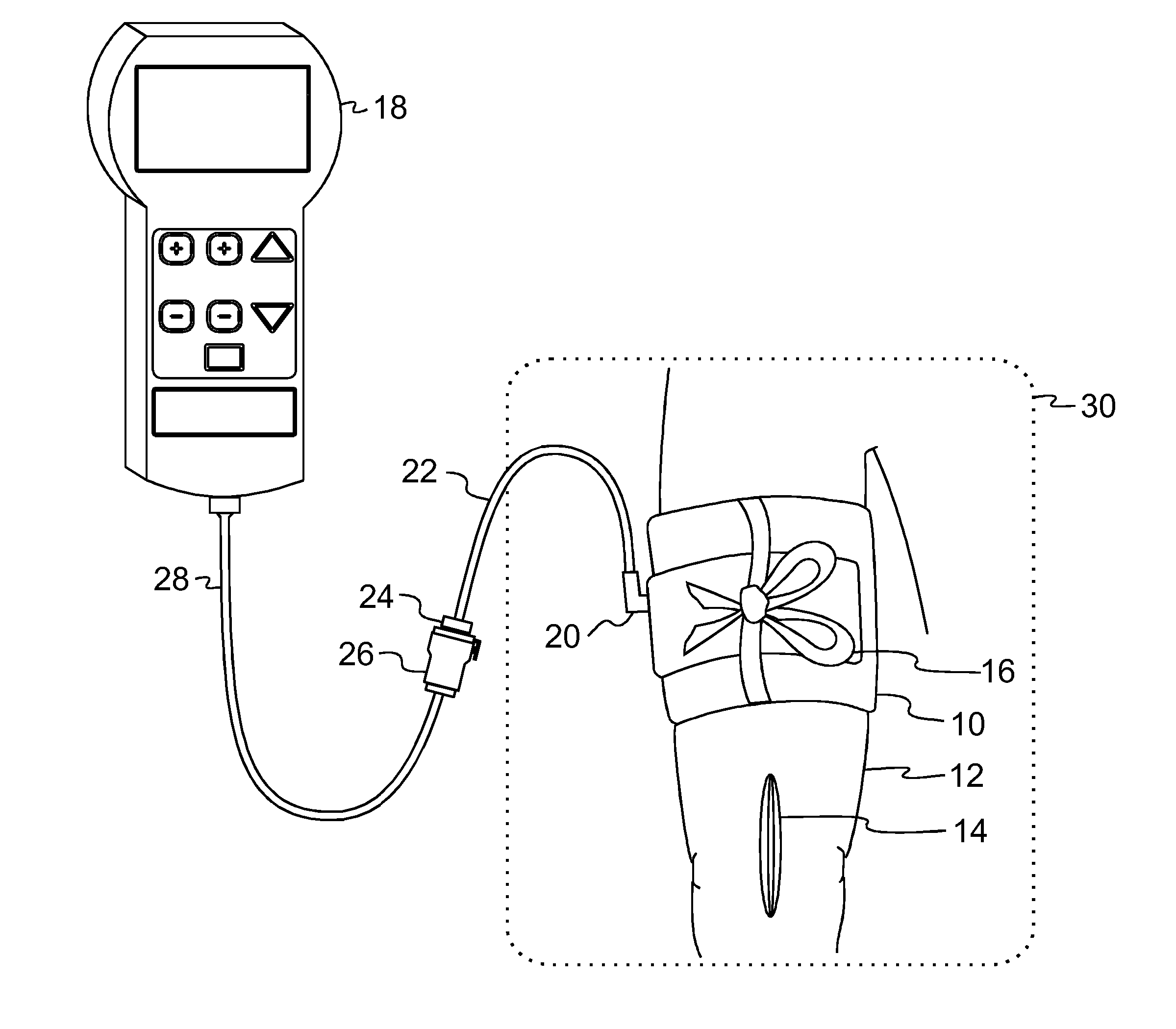 Low-Cost Disposable Tourniquet Cuff Having Improved Safety