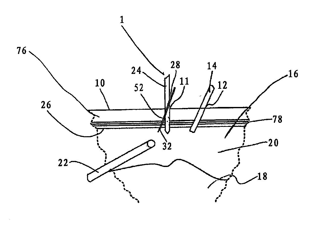 Apparatus and method of laparoscopic port site suture