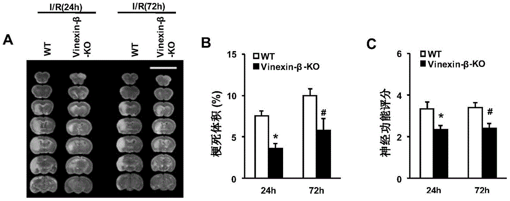 Application of Vinexin-beta in treating cerebral apoplexy