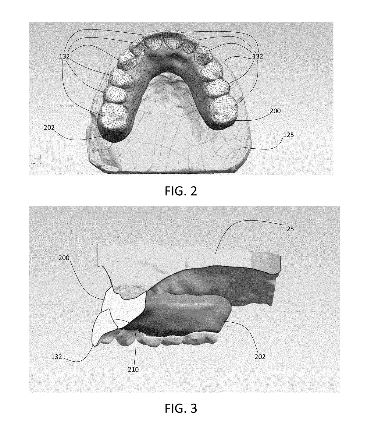 Provisional Dental Restoration