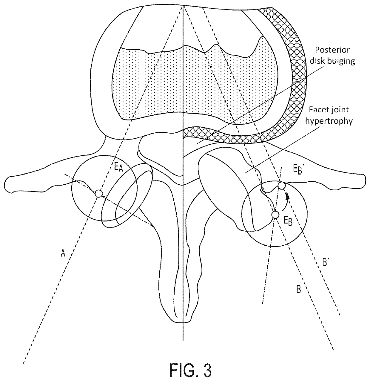 Anti-skid surgical instrument for use in preparing holes in bone tissue