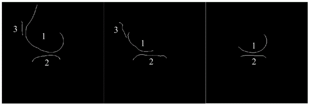 Automatic knee cartilage image partitioning method based on SVM (support vector machine) and elastic region growth