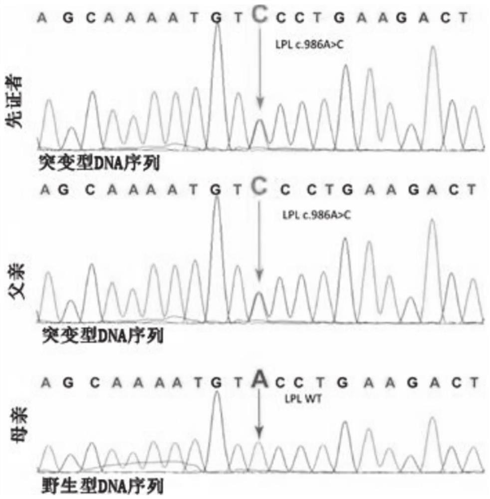 LPL new site mutant gene of hyperlipidemia accompanied by recurrent acute pancreatitis and application of LPL new site mutant gene