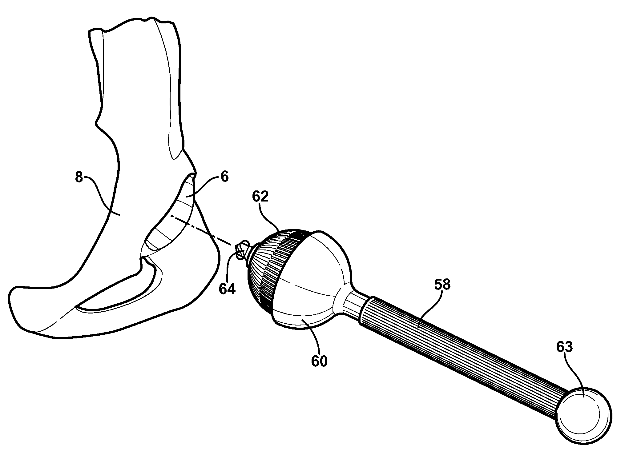 Kit for reconditoning femur and ilium bones in preparation for installation of a joint implant