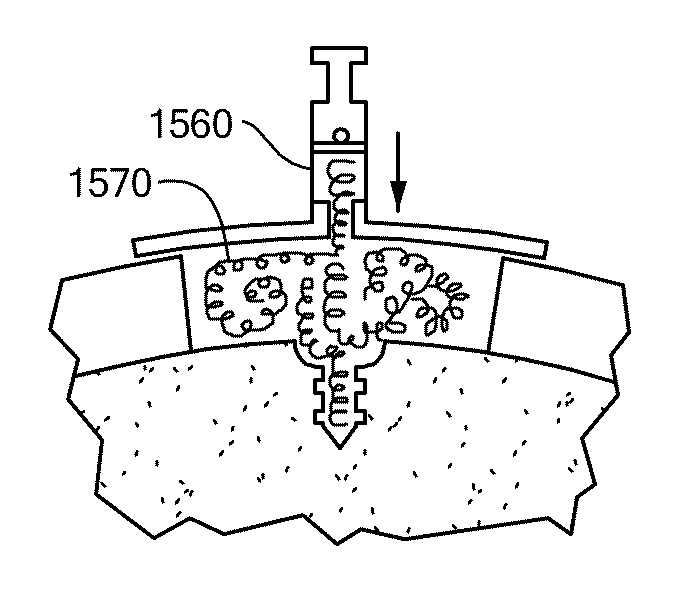 Patient Selectable Joint Arthroplasty Devices and Surgical Tools