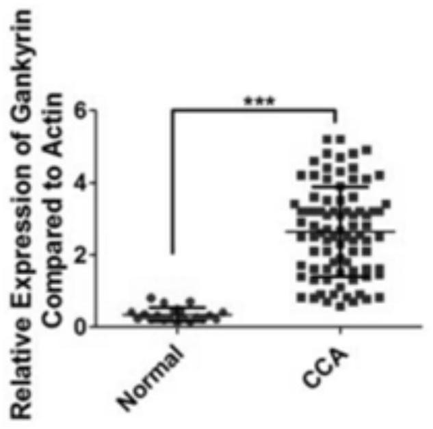 Novel marker for judging malignant tumor of cholangiocarcinoma and application of novel marker