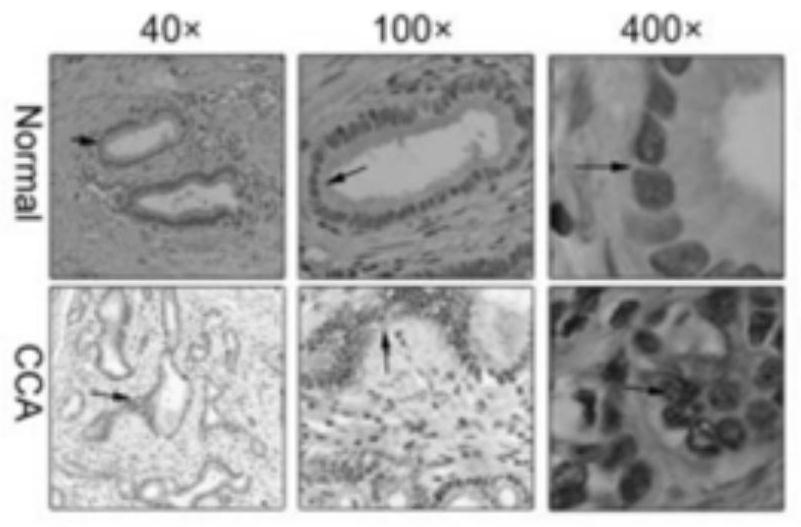 Novel marker for judging malignant tumor of cholangiocarcinoma and application of novel marker