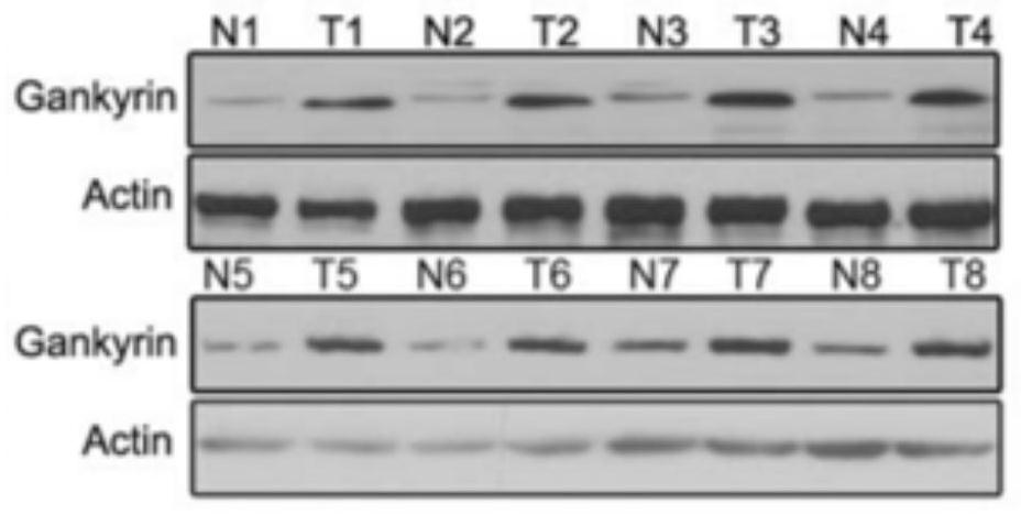 Novel marker for judging malignant tumor of cholangiocarcinoma and application of novel marker