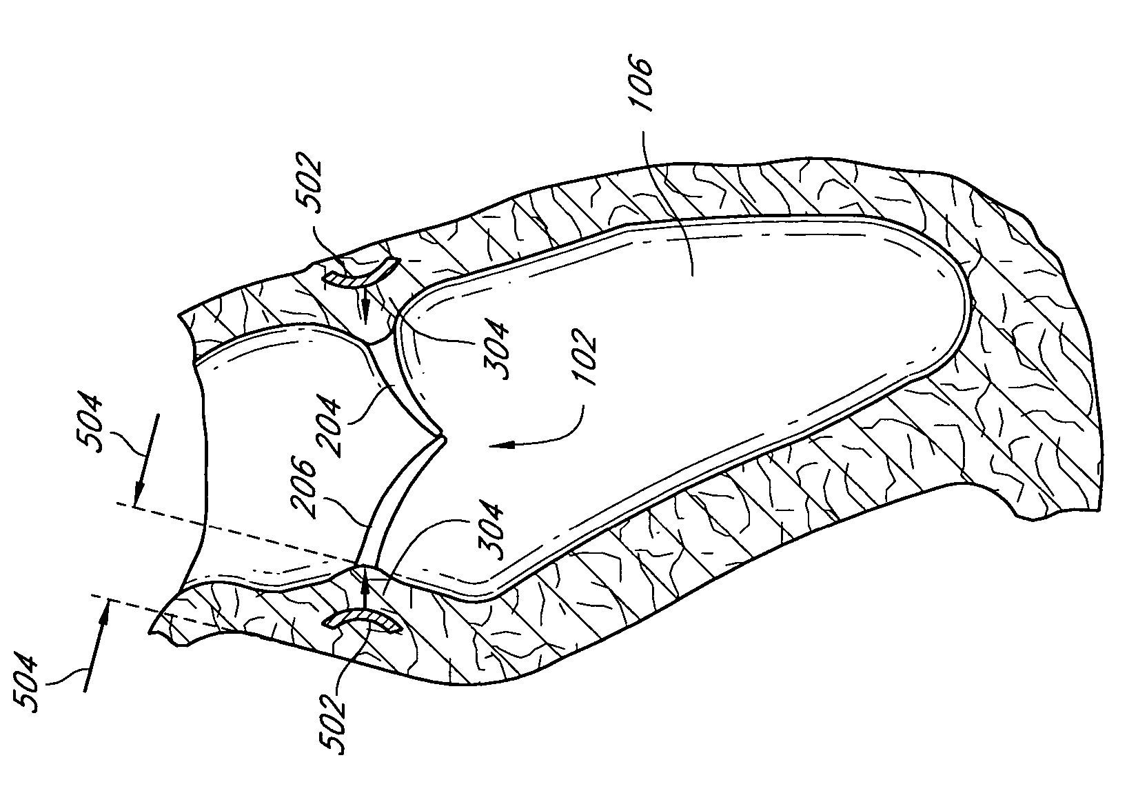 Implants and methods for reshaping heart valves