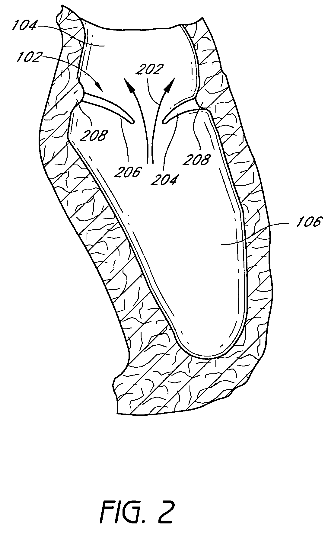 Implants and methods for reshaping heart valves