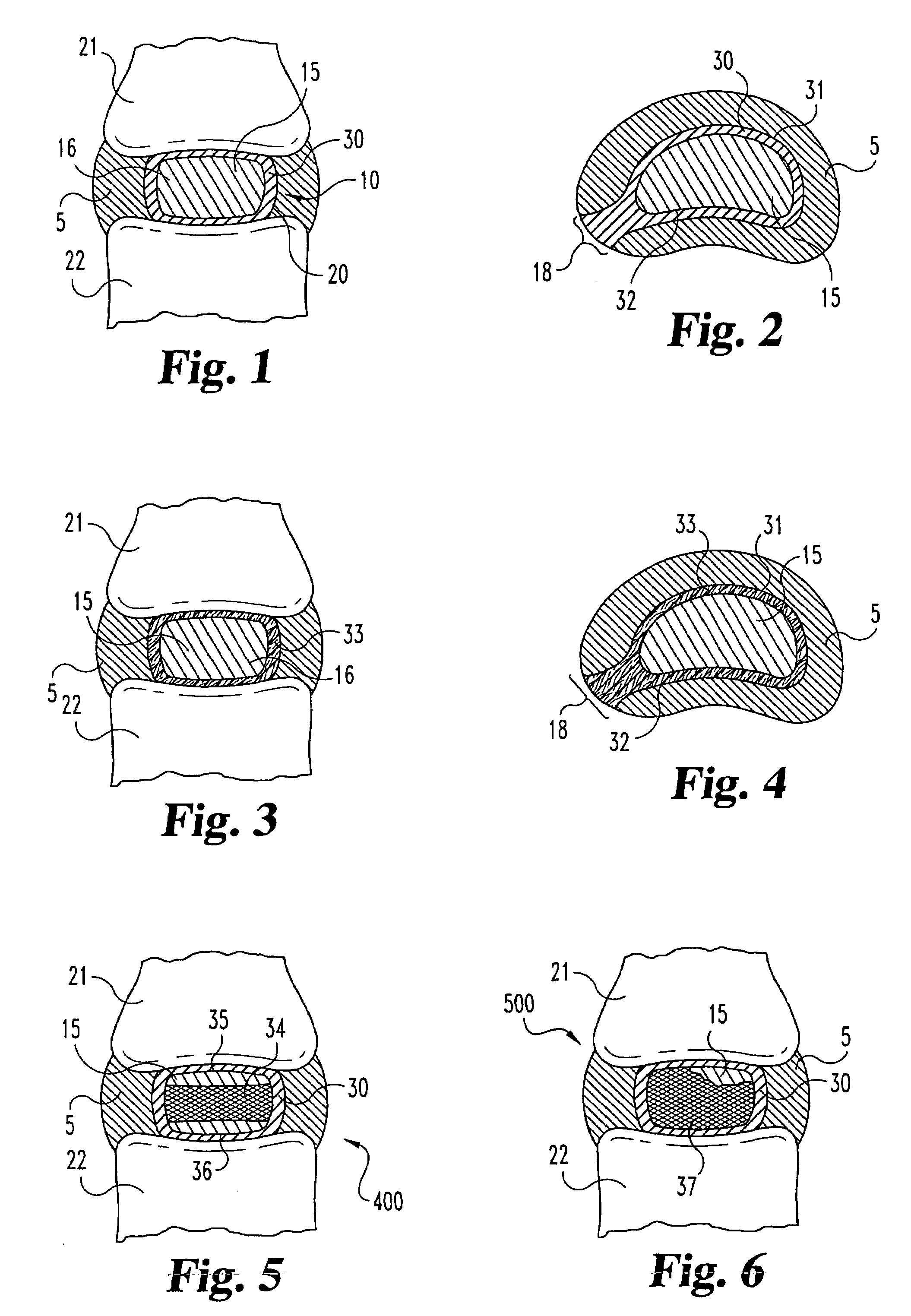 Methods for forming and retaining intervertebral disc implants