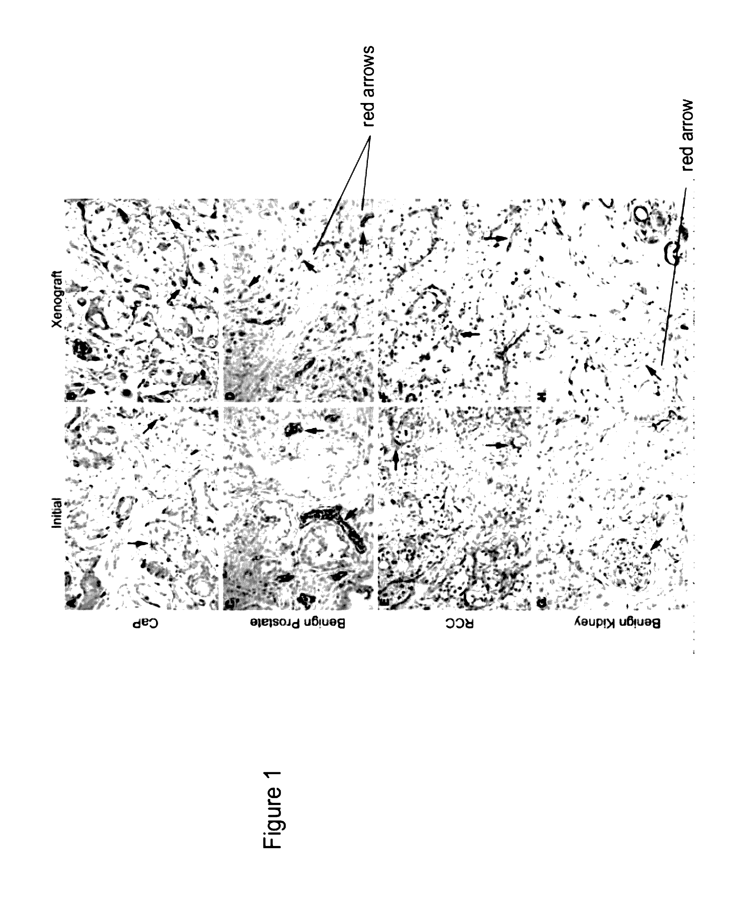 Methods for evaluating and implementing prostate disease treatments