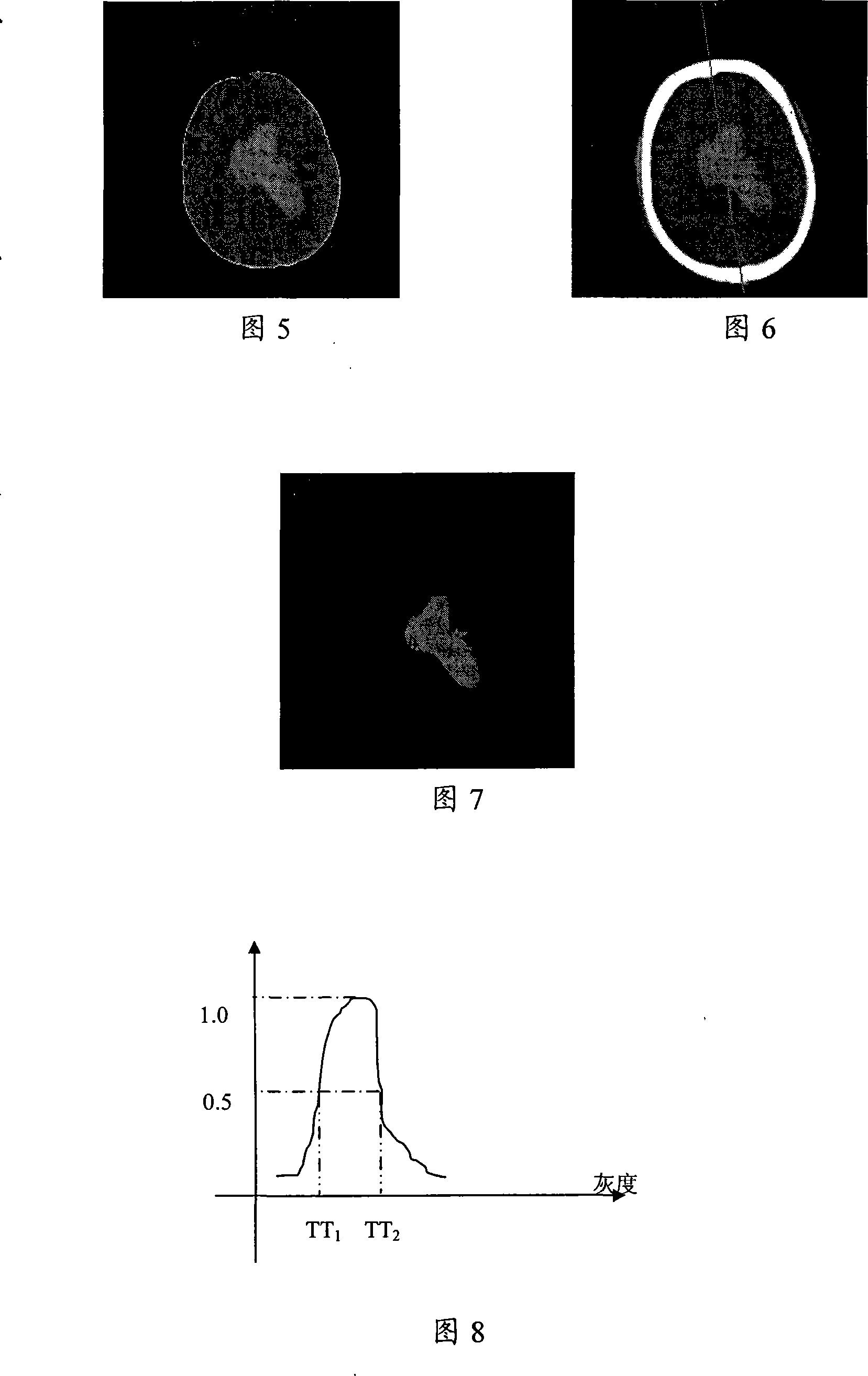 Processing method of CT cerebral hemorrhage image