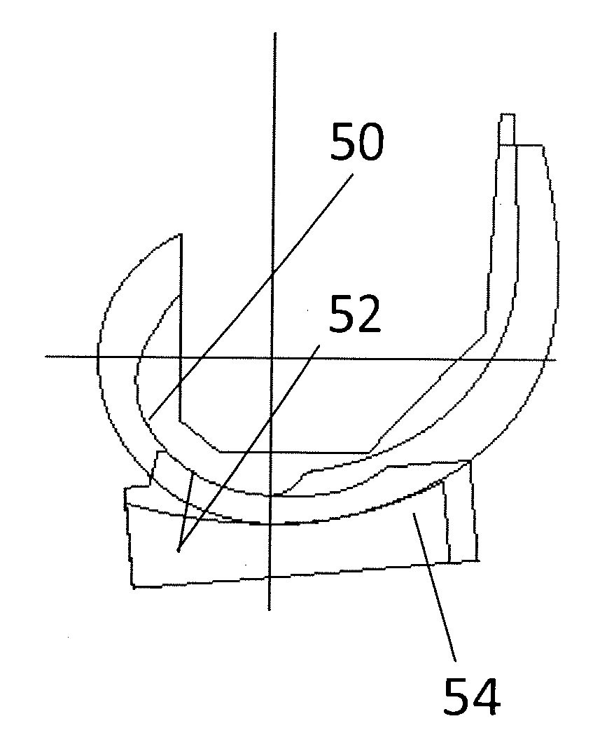 Total knee replacement substituting function of anterior cruciate ligament