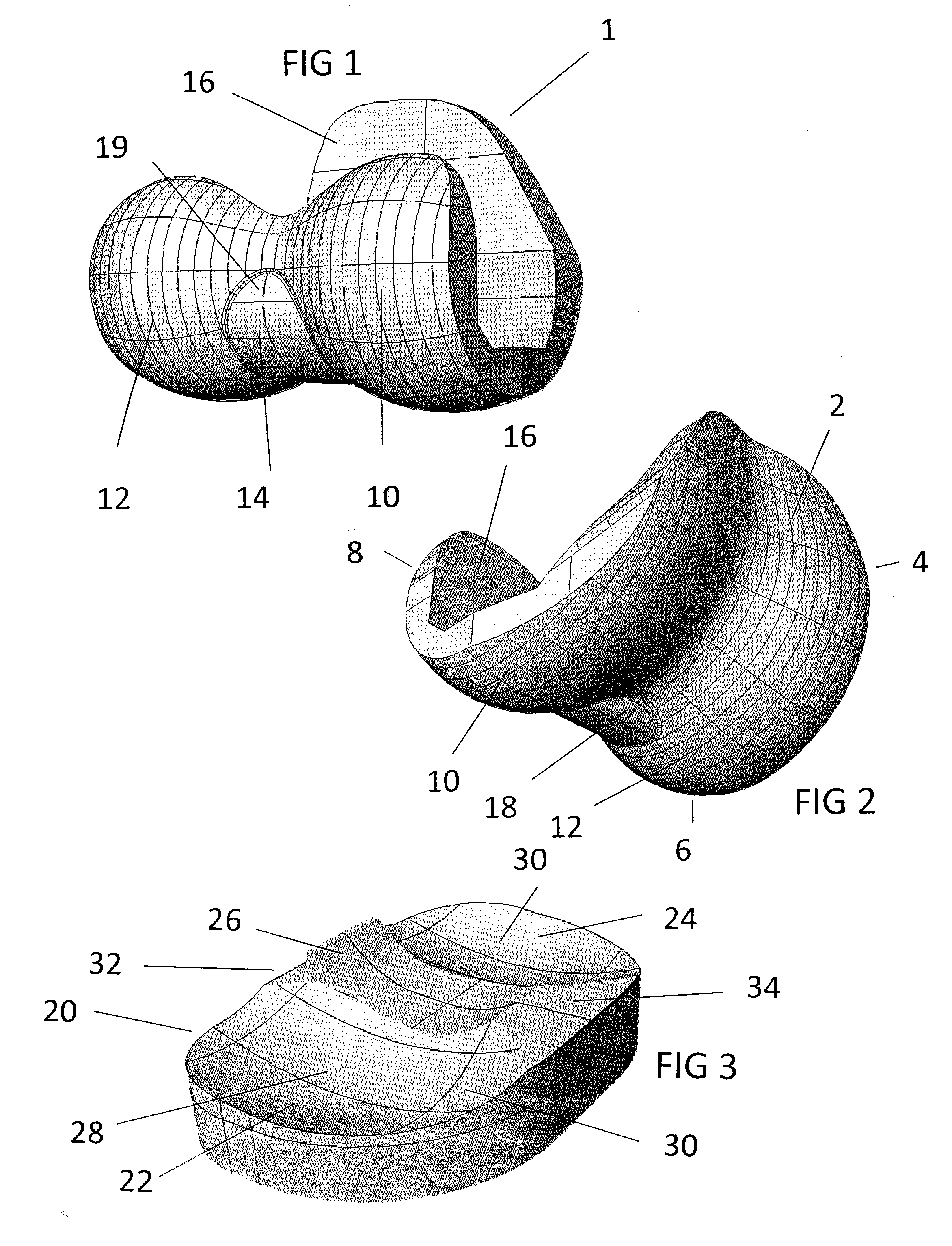 Total knee replacement substituting function of anterior cruciate ligament