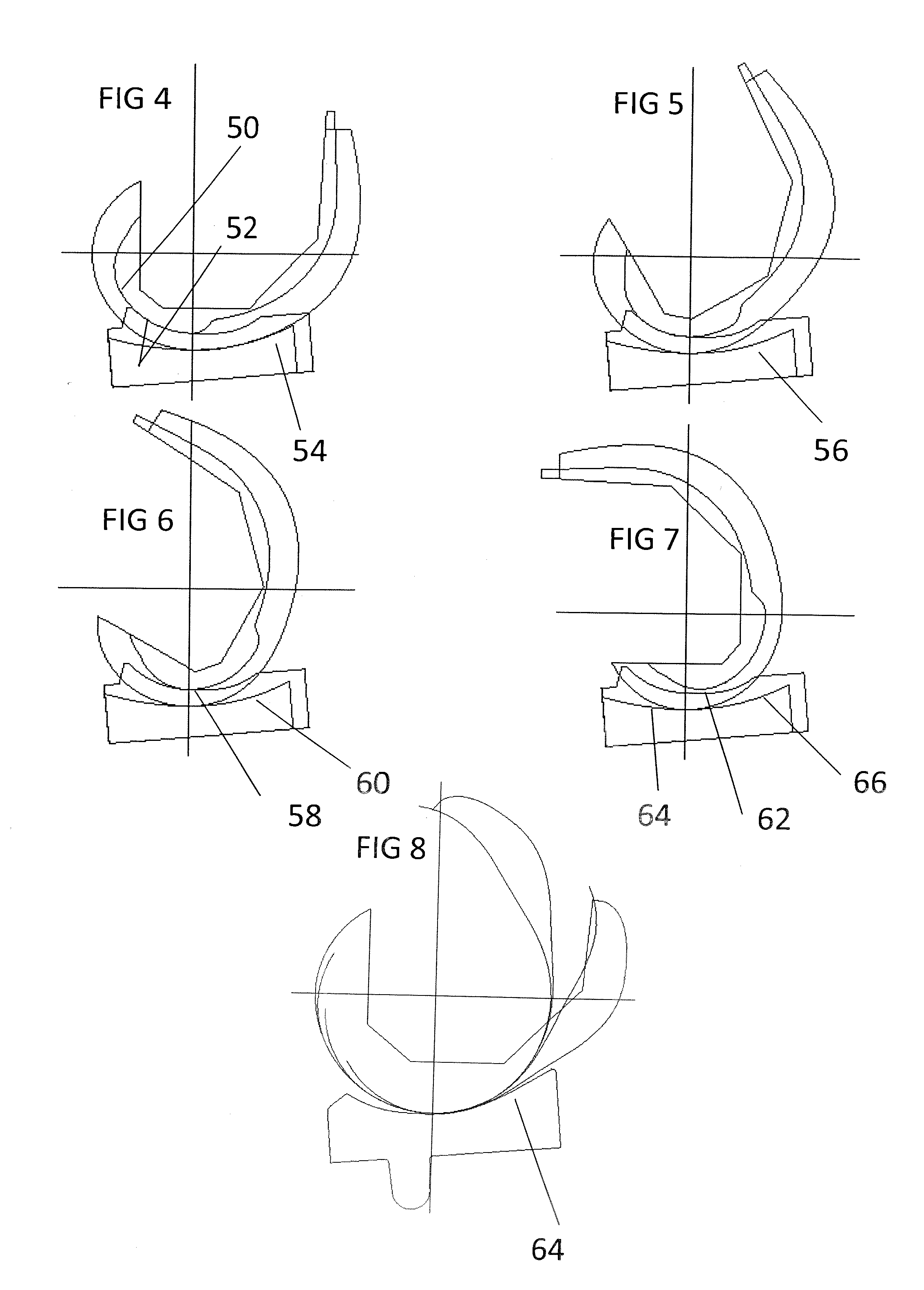 Total knee replacement substituting function of anterior cruciate ligament