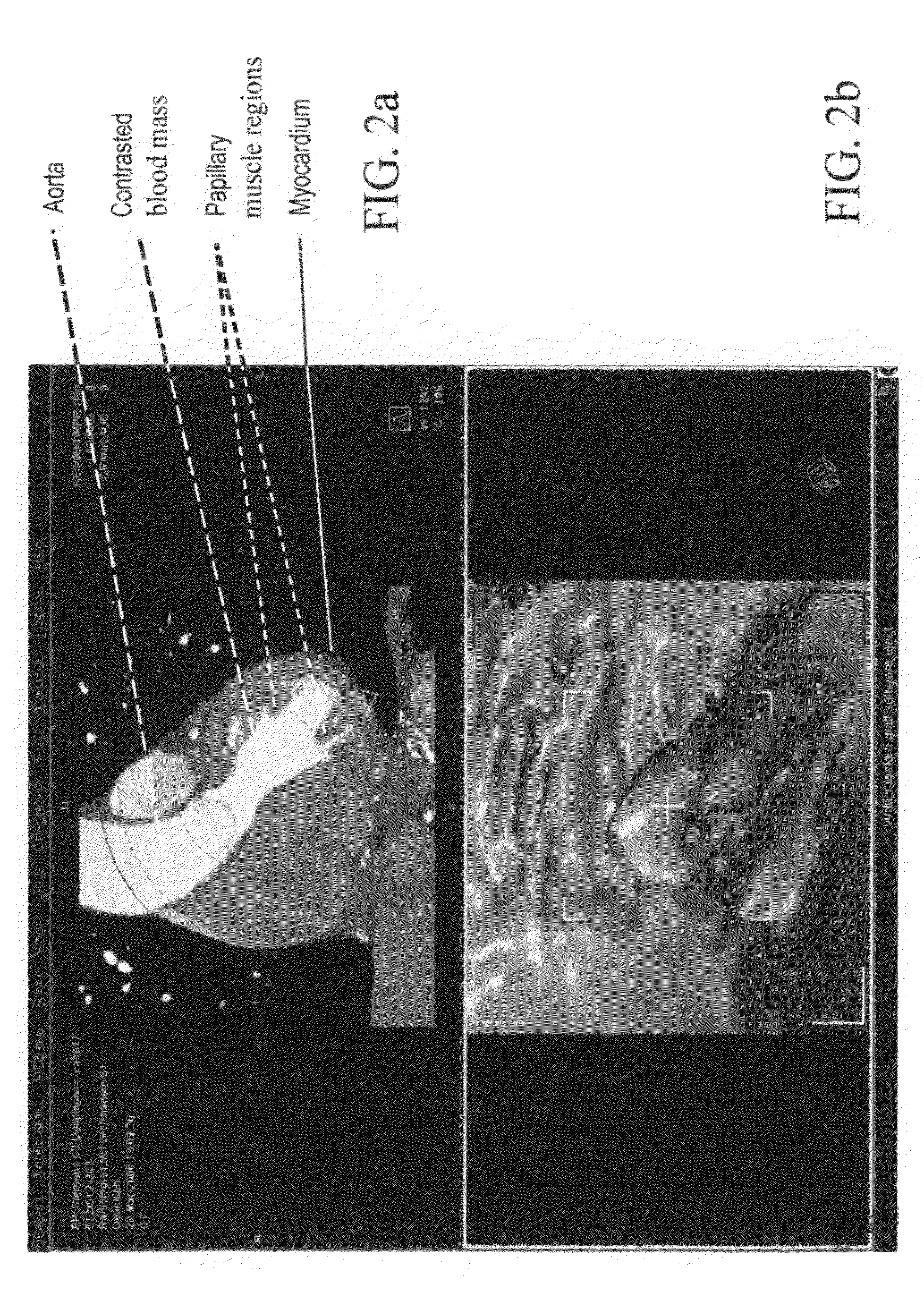 Method and system for performing ablation to treat ventricular tachycardia