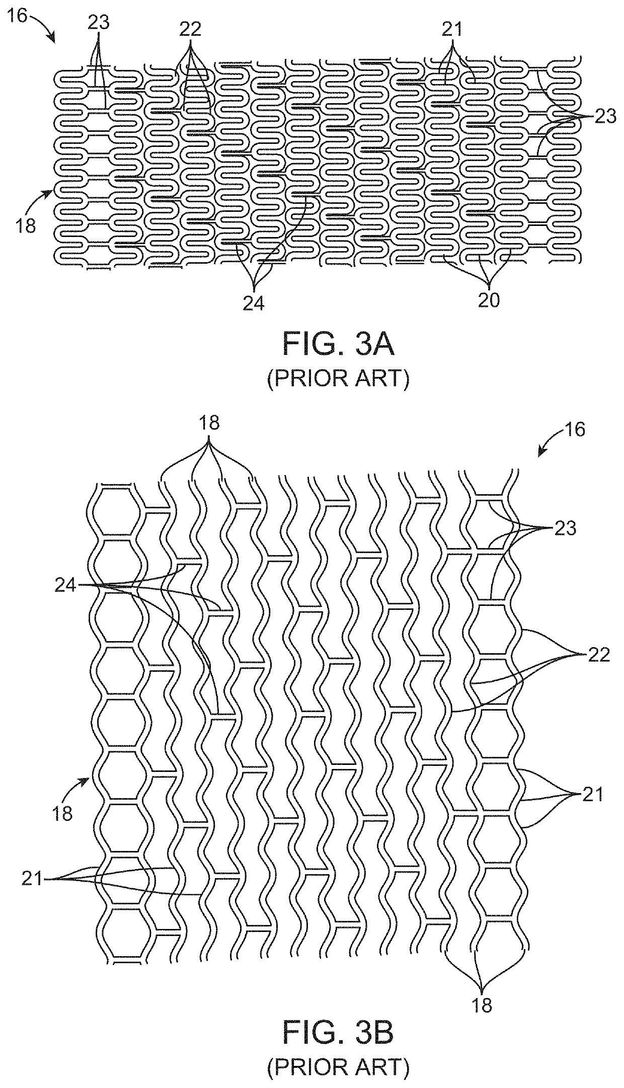 Uncaging stent