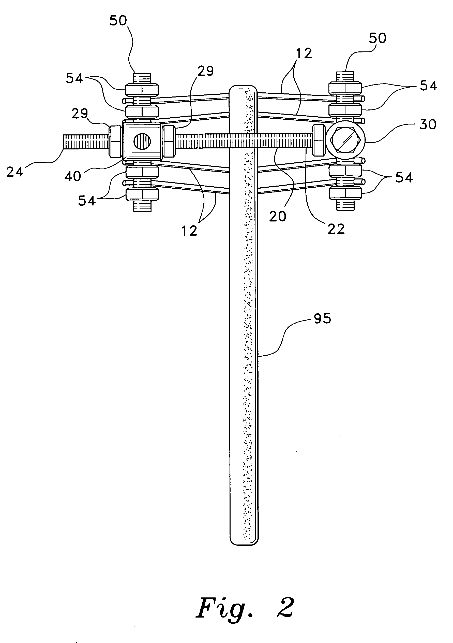 Method and apparatus for external fixation of bone fractures