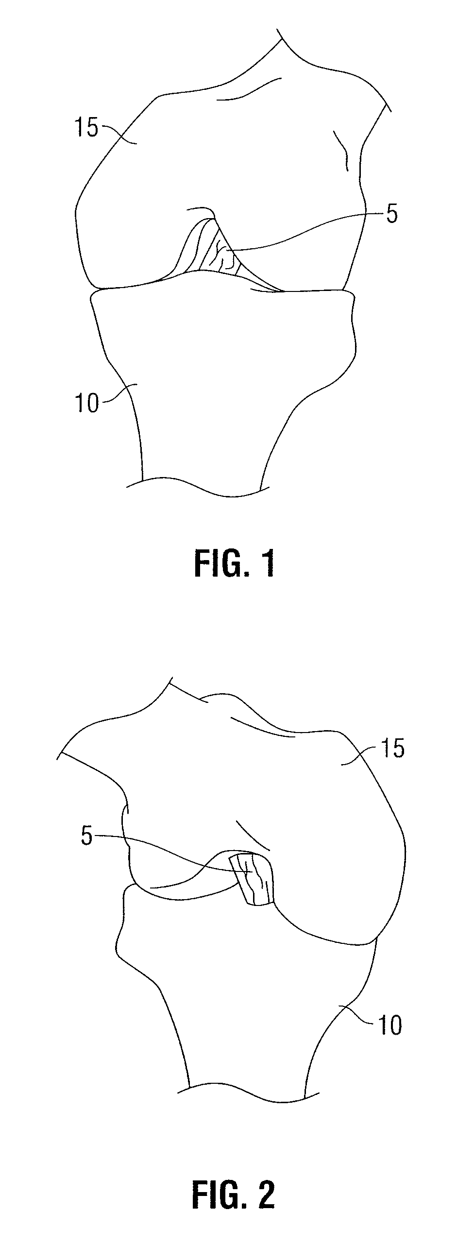 Tibial guide for acl repair having interchangeable and/or rotatable outrigger