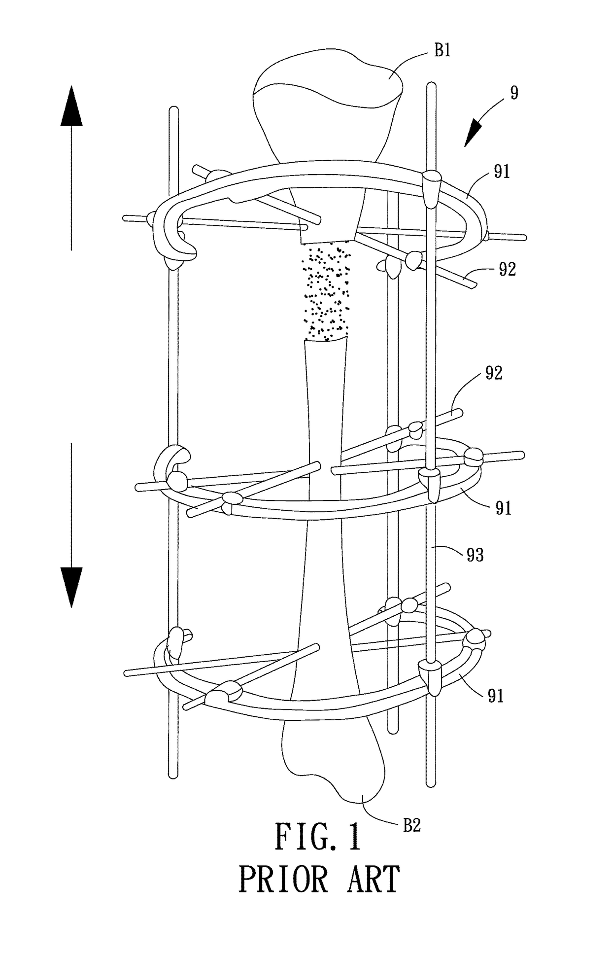 Adjustable External Fixator