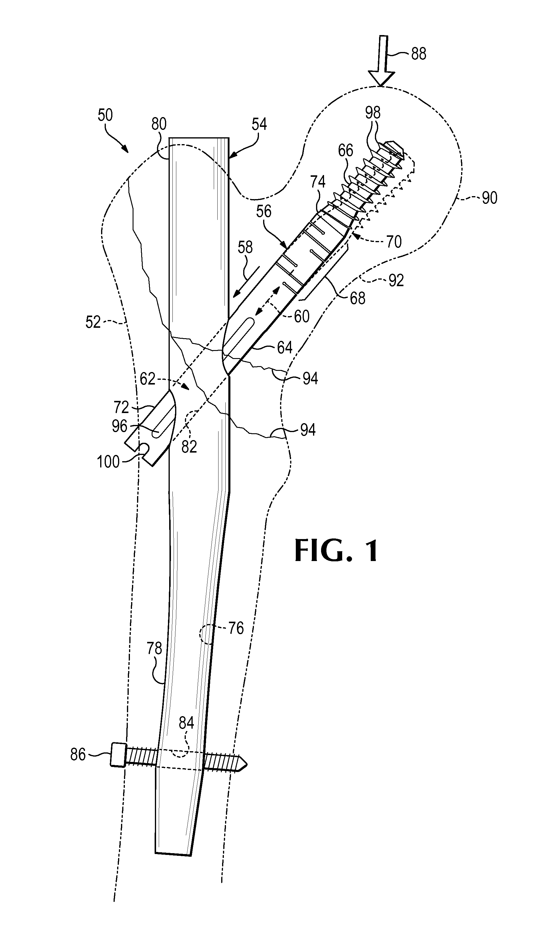 Hip fixation system with a compliant fixation element