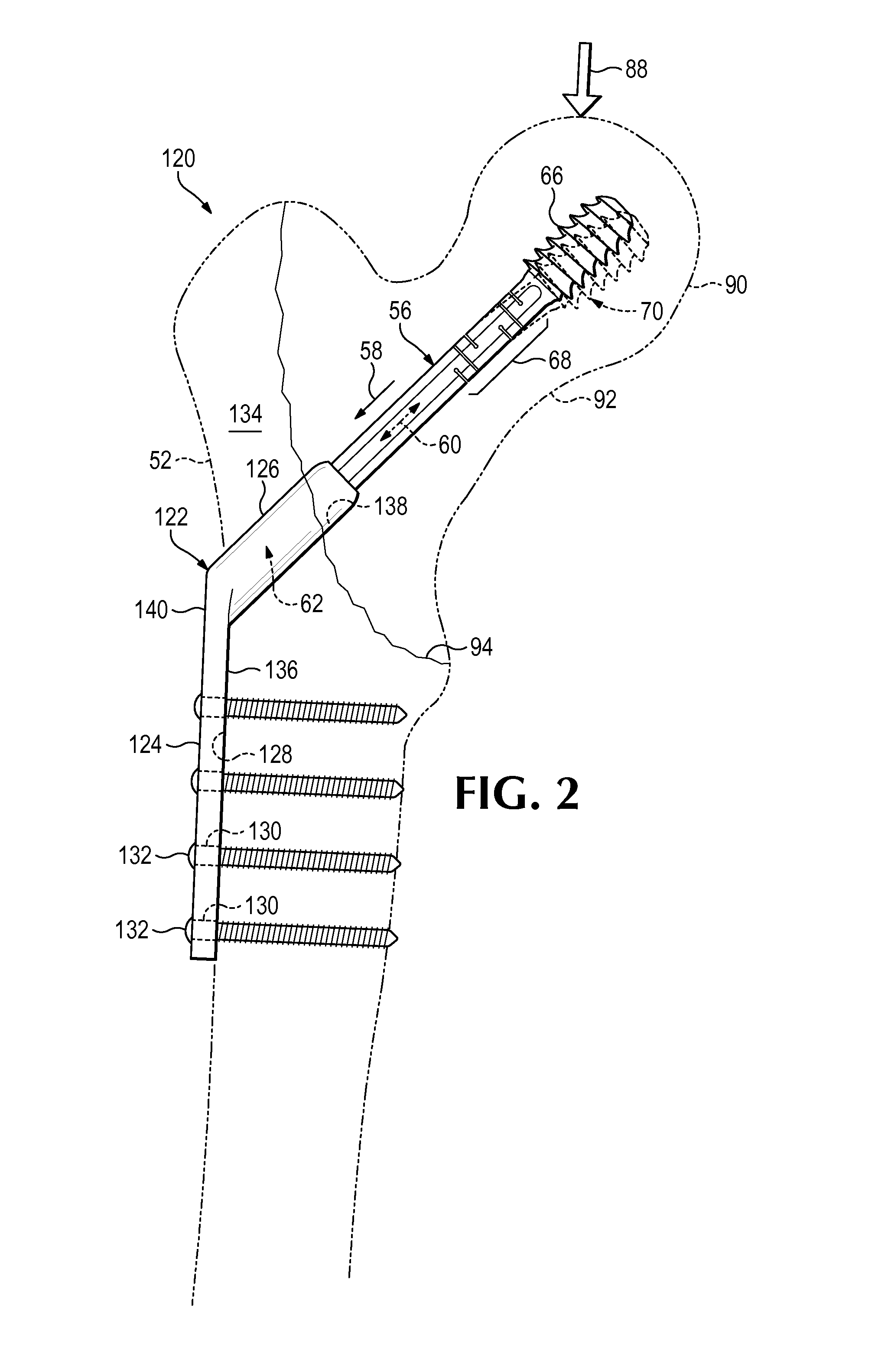 Hip fixation system with a compliant fixation element