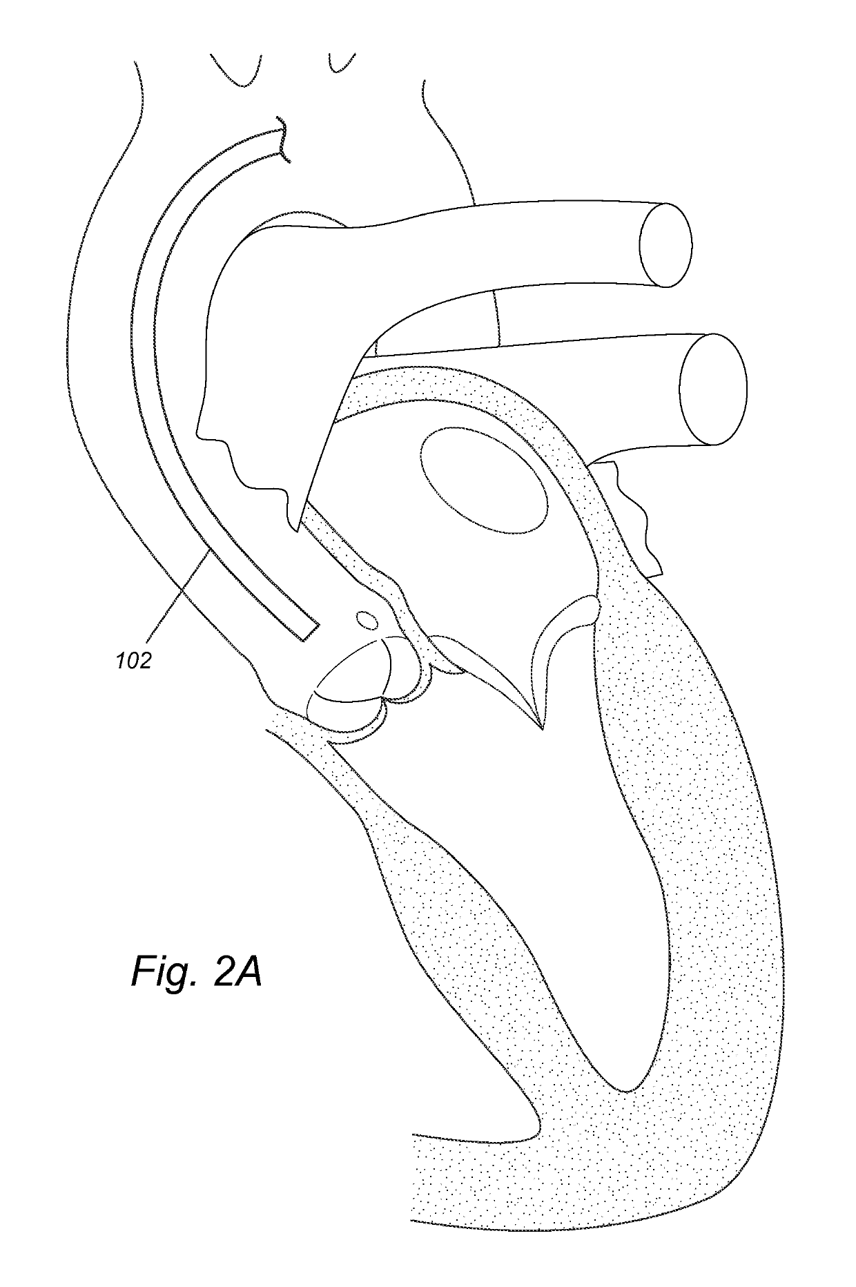 Pigtail for optimal aortic valvular complex imaging and alignment